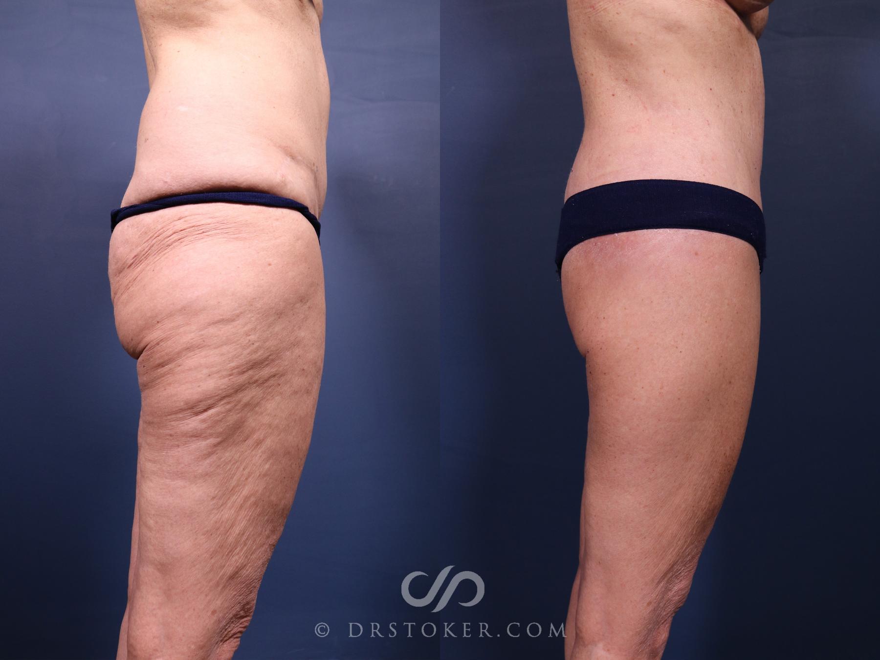 Before & After Revision Tummy Tuck  Case 2696 Right Side View in Los Angeles, CA