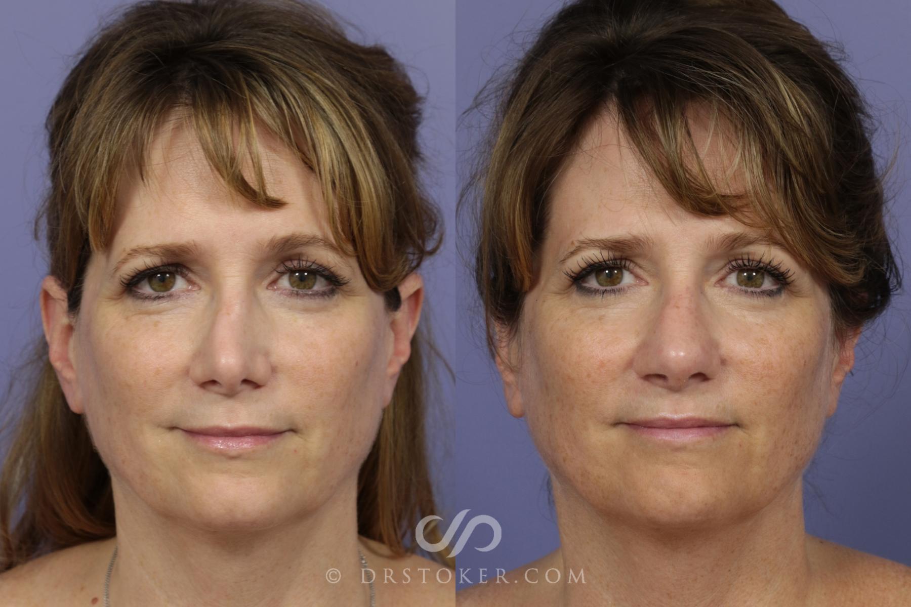 Before & After Rhinoplasty Case 1117 View #2 View in Los Angeles, CA