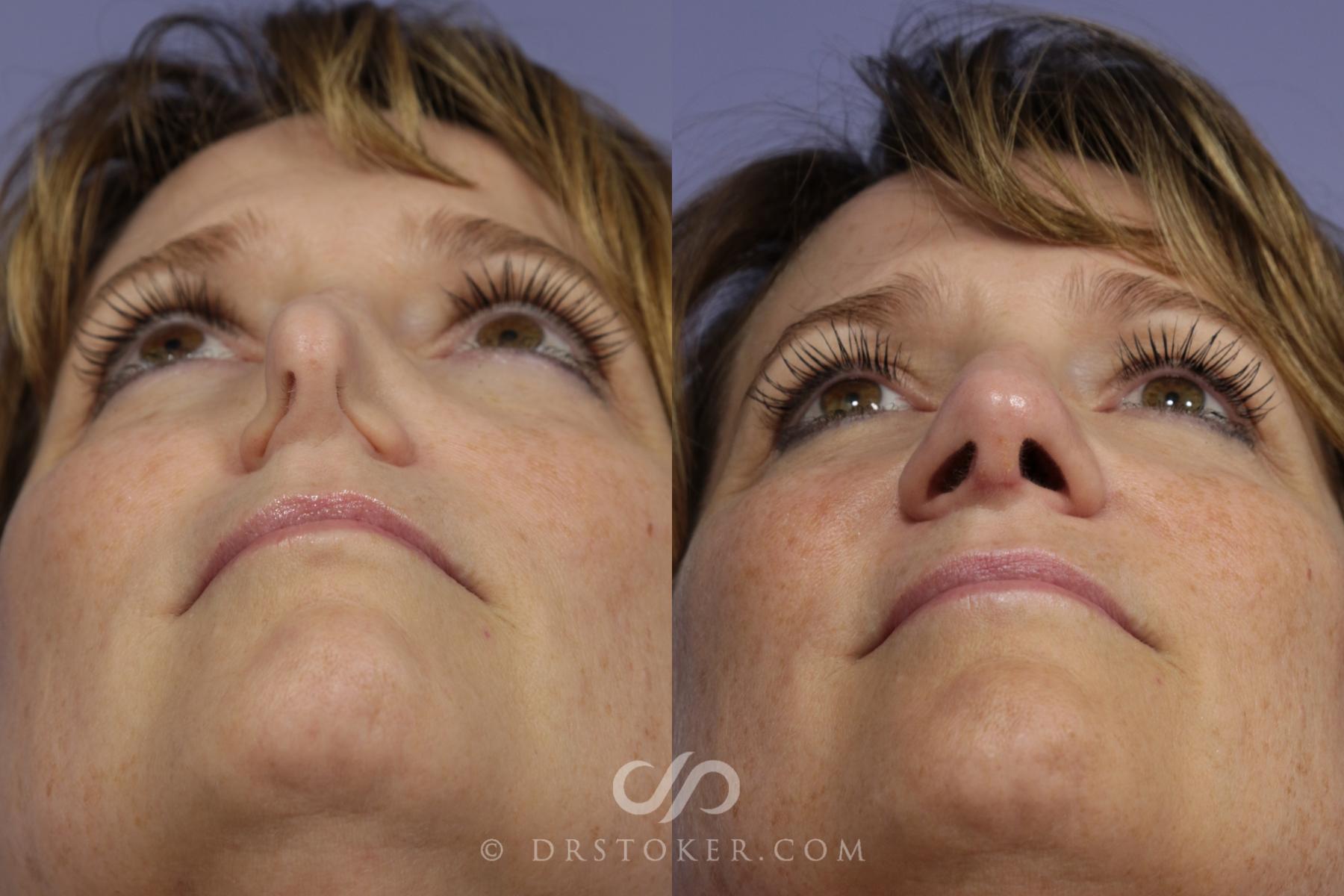 Before & After Rhinoplasty Case 1117 View #3 View in Los Angeles, CA