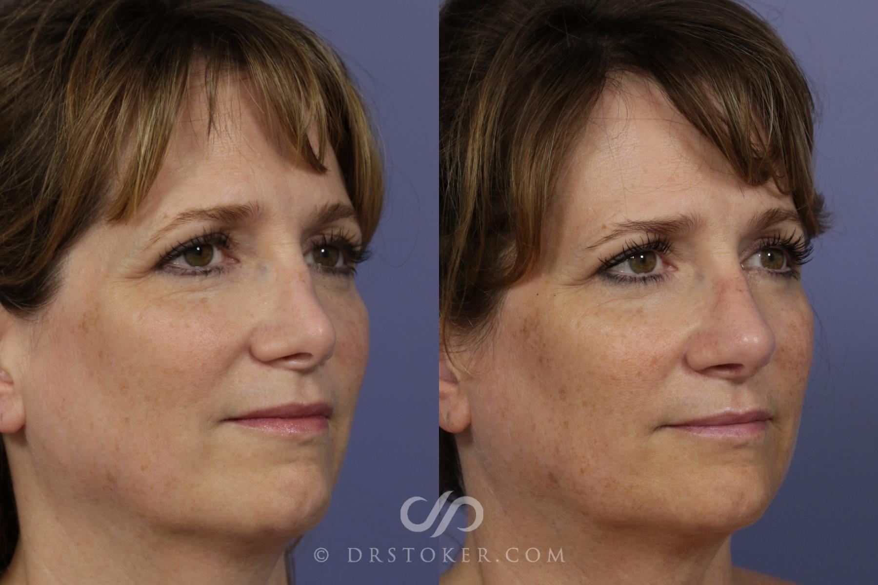 Before & After Rhinoplasty Case 1117 View #4 View in Los Angeles, CA