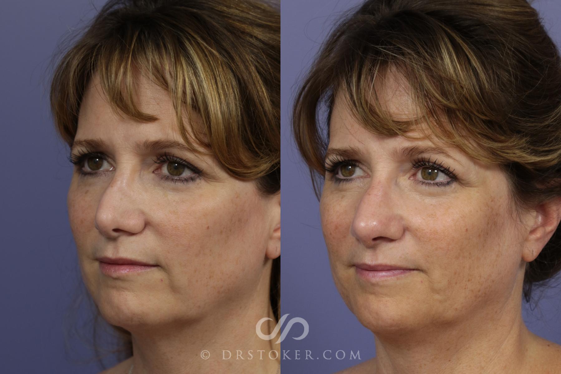 Before & After Rhinoplasty Case 1117 View #5 View in Los Angeles, CA