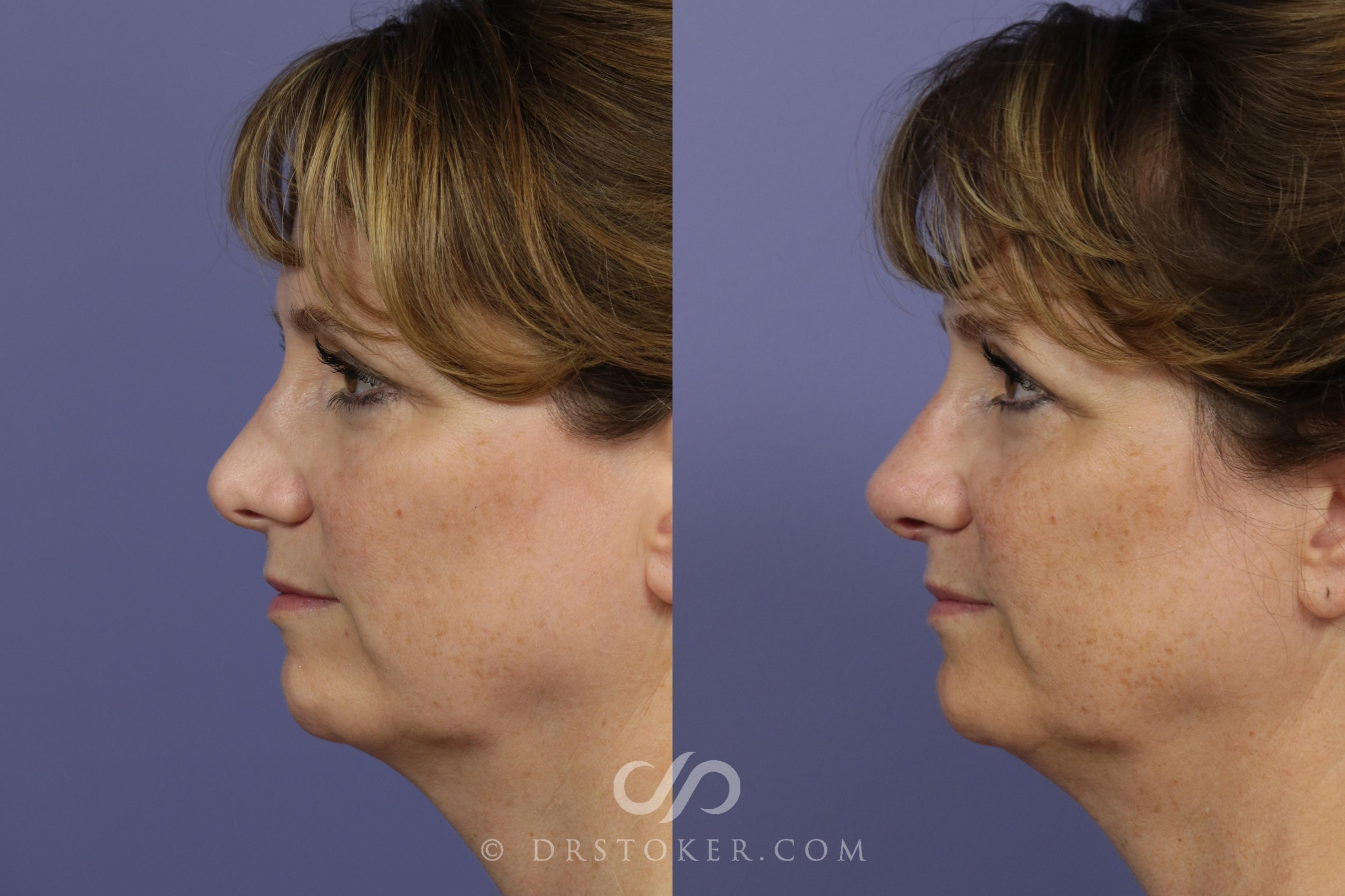 Before & After Rhinoplasty Case 1117 View #6 View in Los Angeles, CA