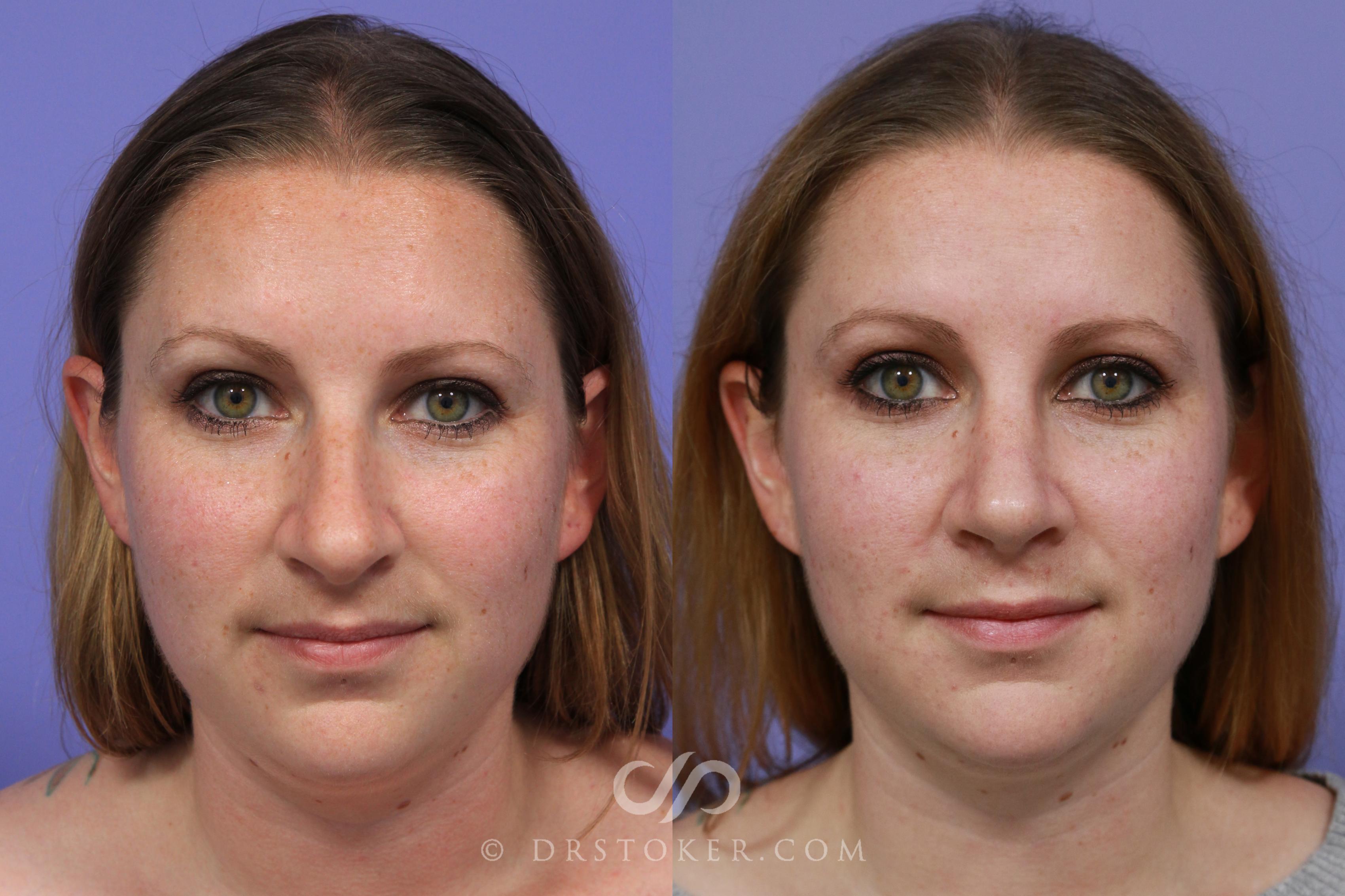 Before & After Rhinoplasty Case 1118 View #1 View in Los Angeles, CA