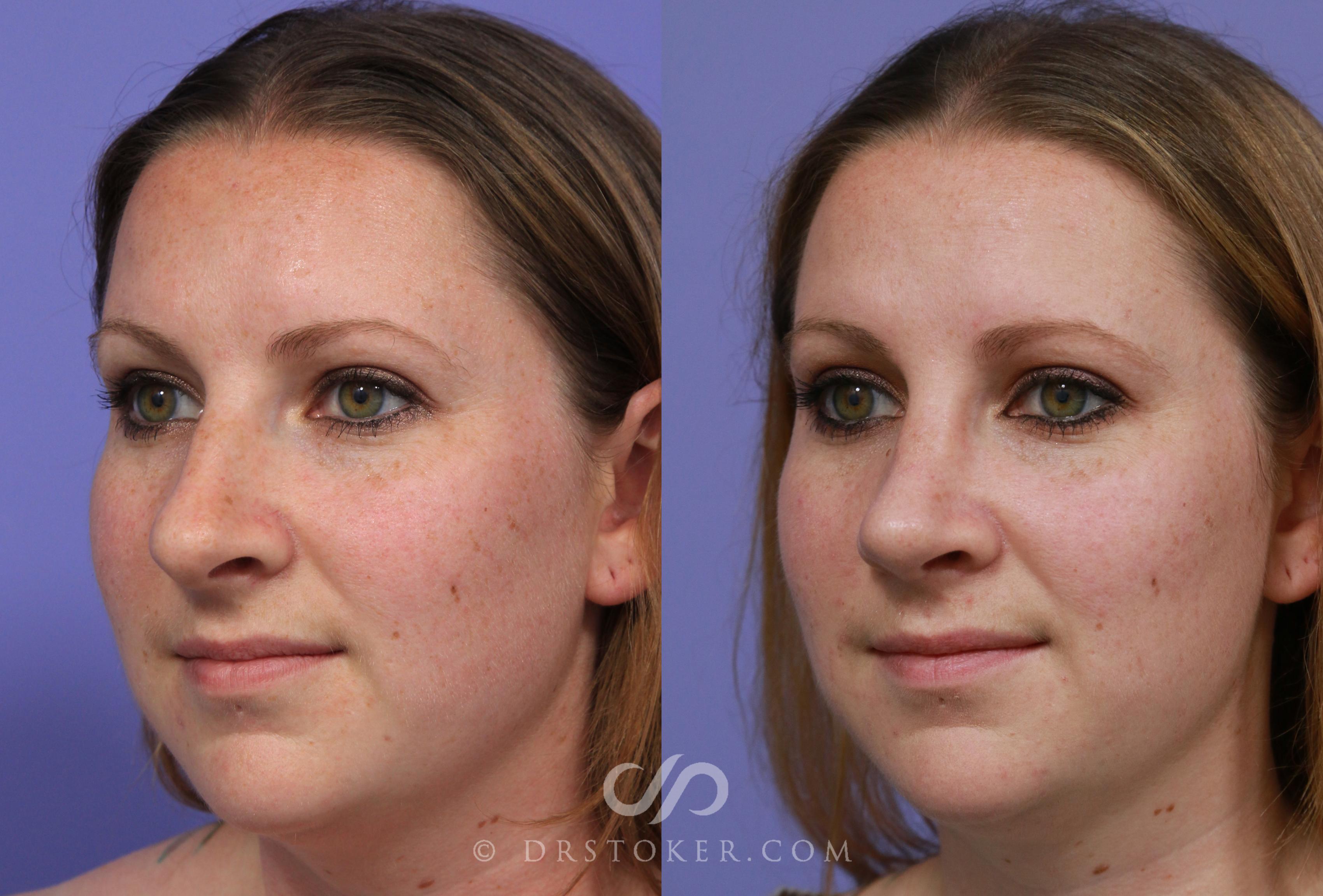 Before & After Rhinoplasty Case 1118 View #3 View in Los Angeles, CA