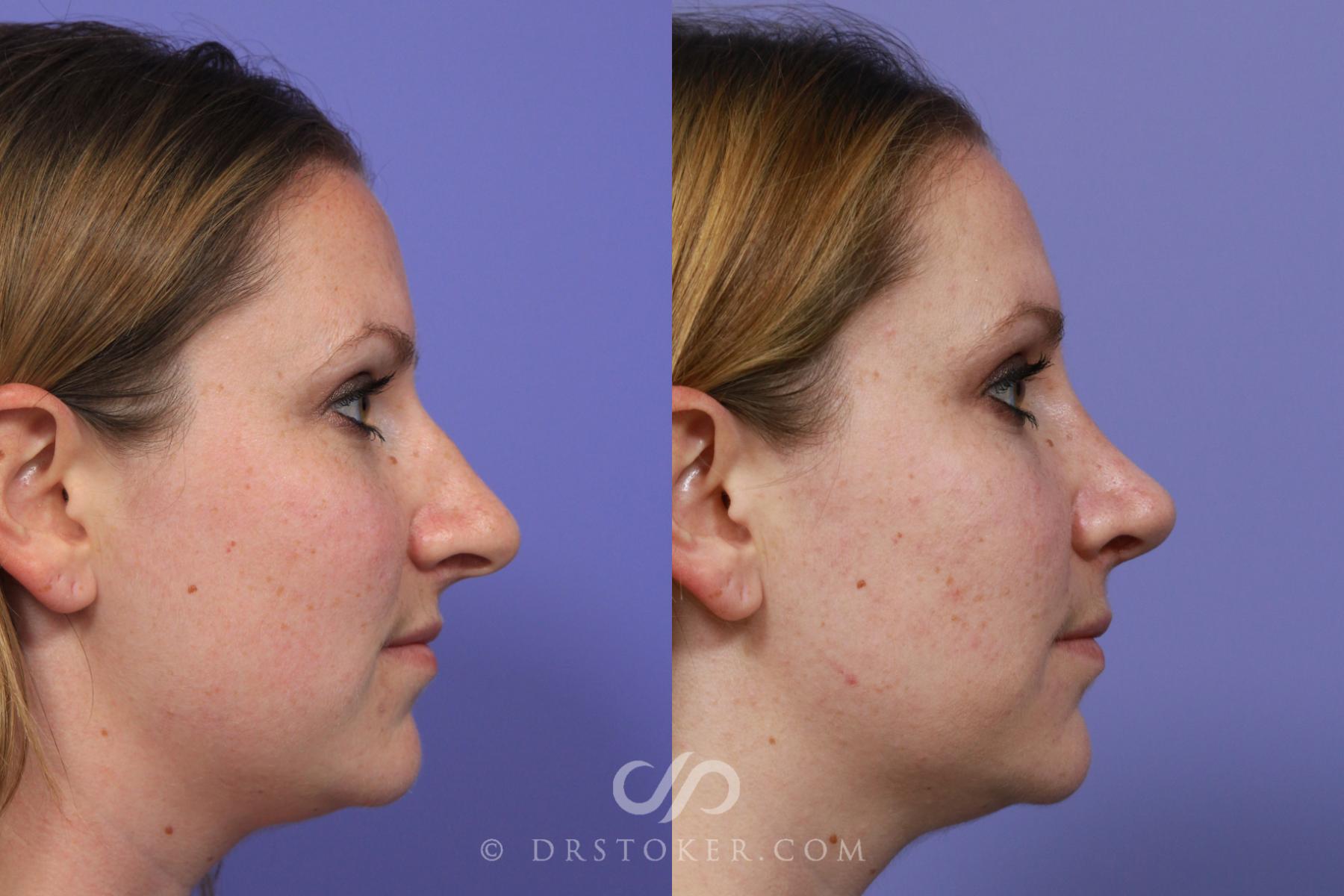 Before & After Rhinoplasty Case 1118 View #4 View in Los Angeles, CA