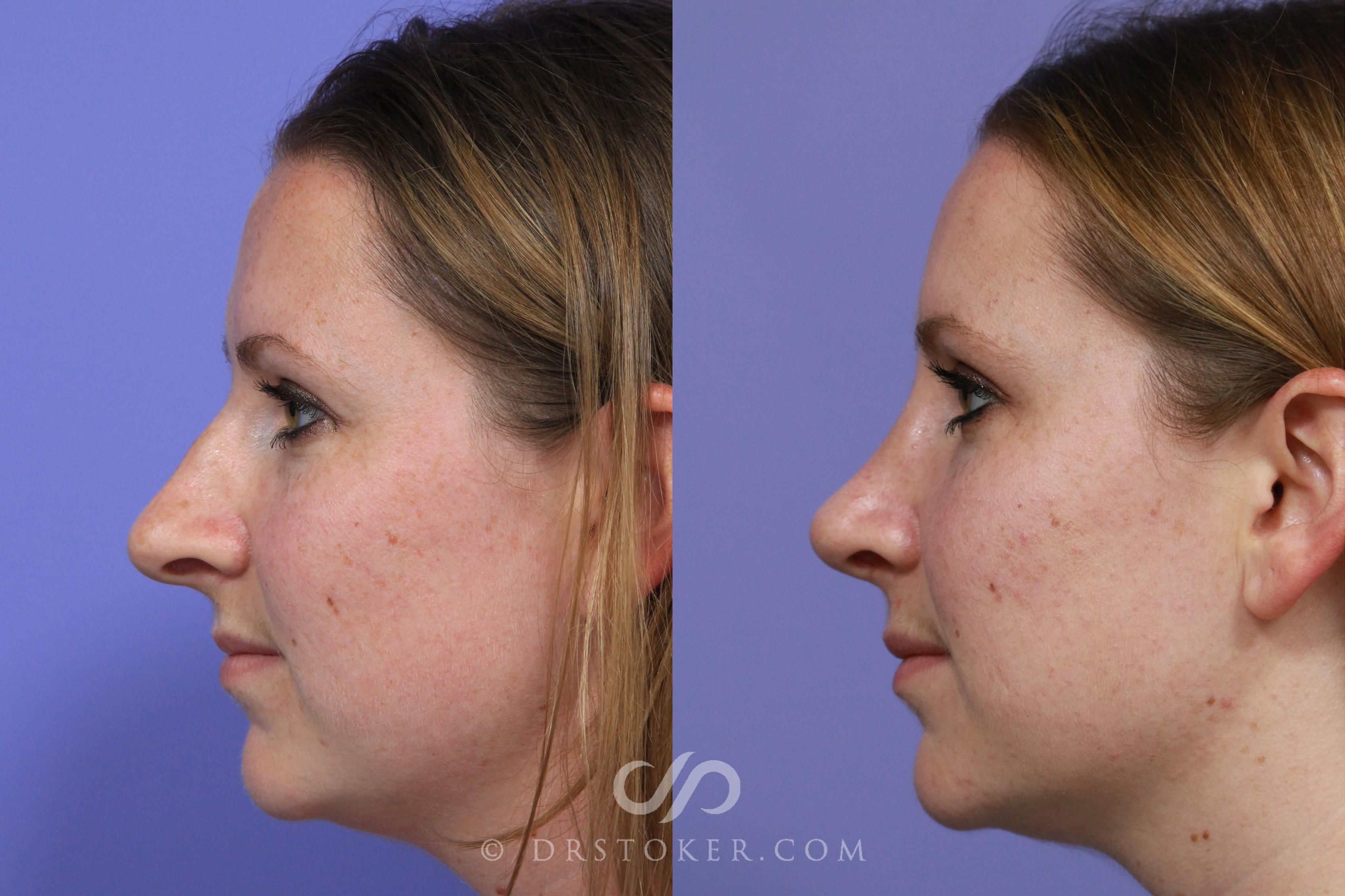 Before & After Rhinoplasty Case 1118 View #5 View in Los Angeles, CA