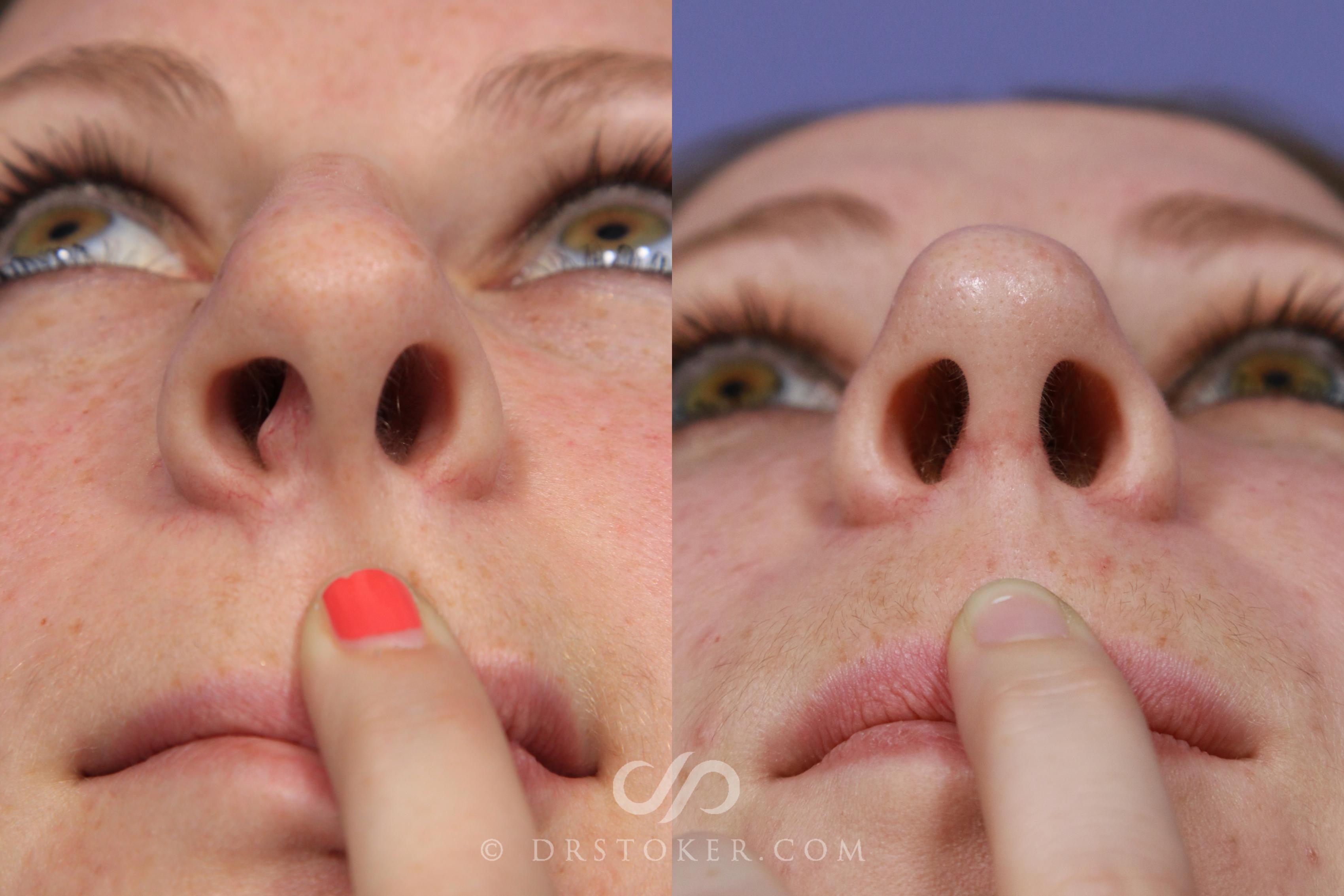 Before & After Rhinoplasty Case 1118 View #6 View in Los Angeles, CA