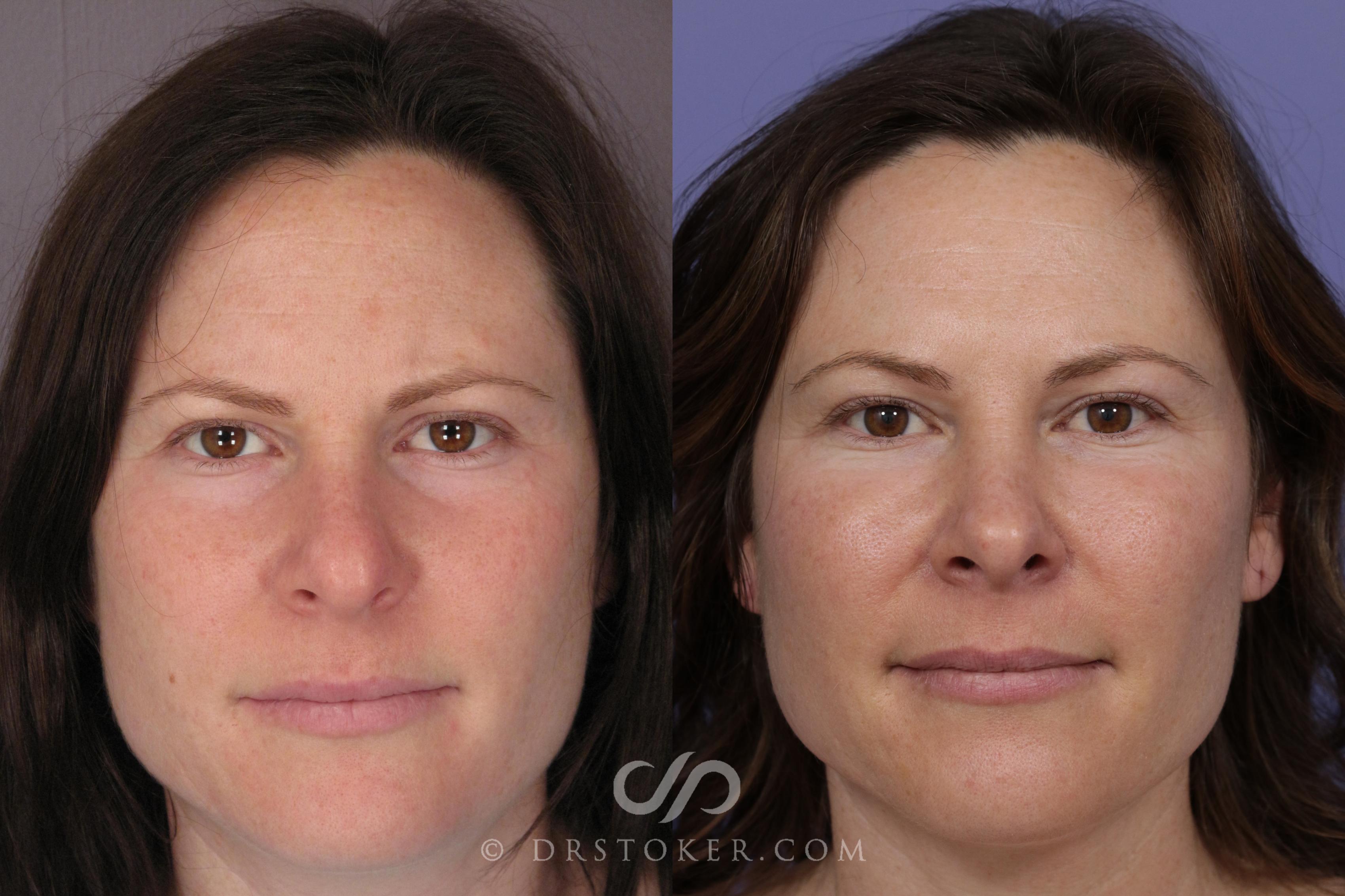 Before & After Rhinoplasty Case 1120 View #1 View in Los Angeles, CA
