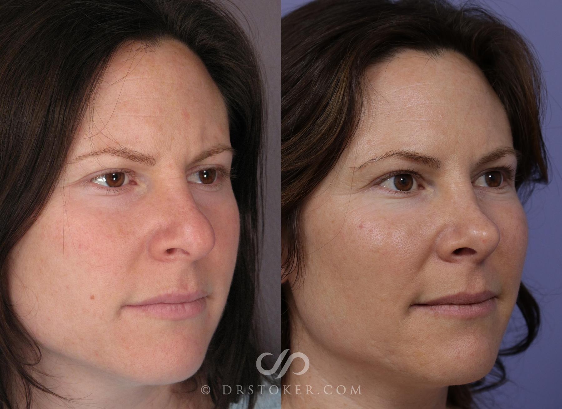 Before & After Rhinoplasty Case 1120 View #2 View in Los Angeles, CA