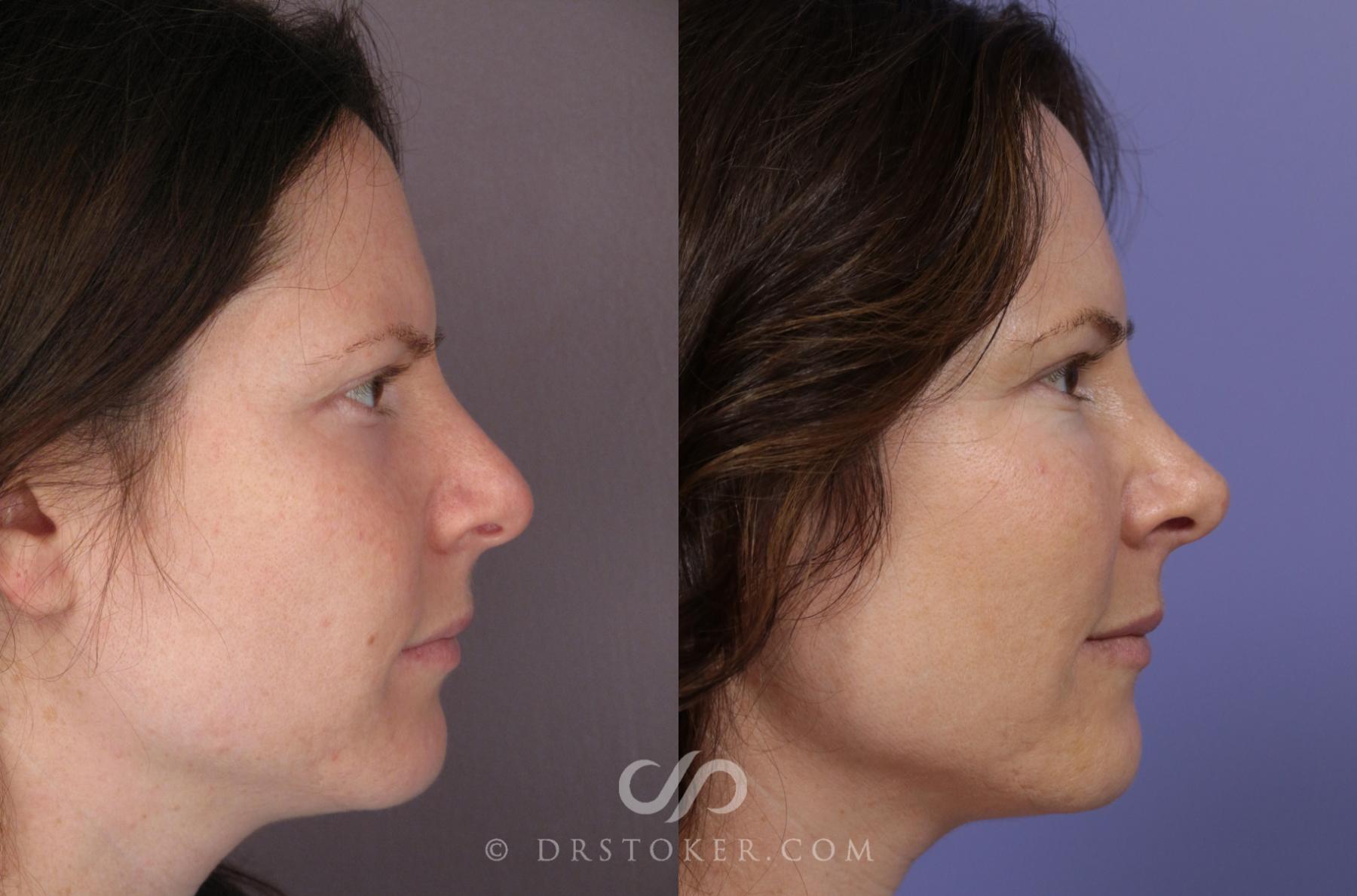 Before & After Rhinoplasty Case 1120 View #3 View in Los Angeles, CA