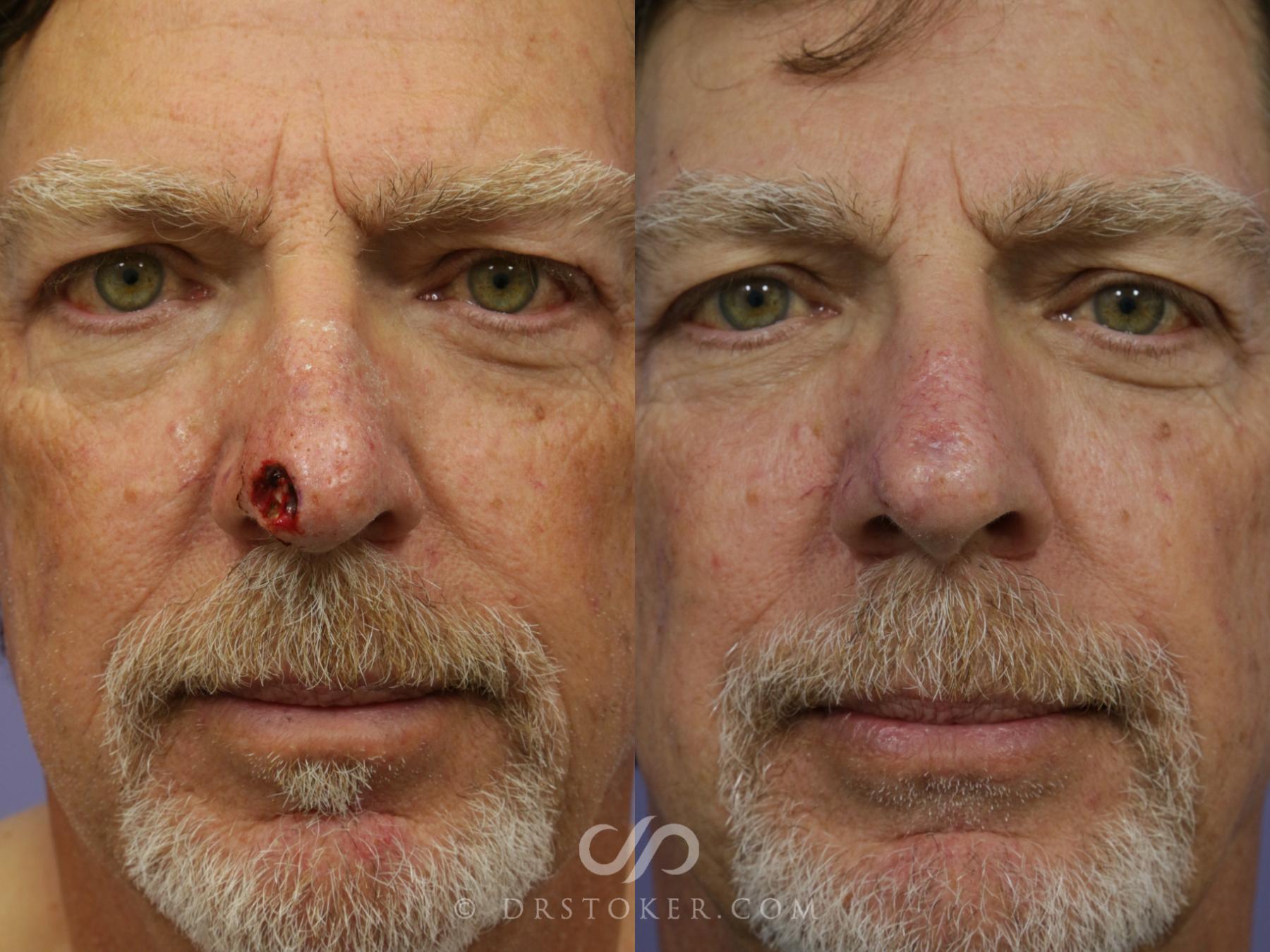 Before & After Rhinoplasty Case 1121 View #1 View in Los Angeles, CA