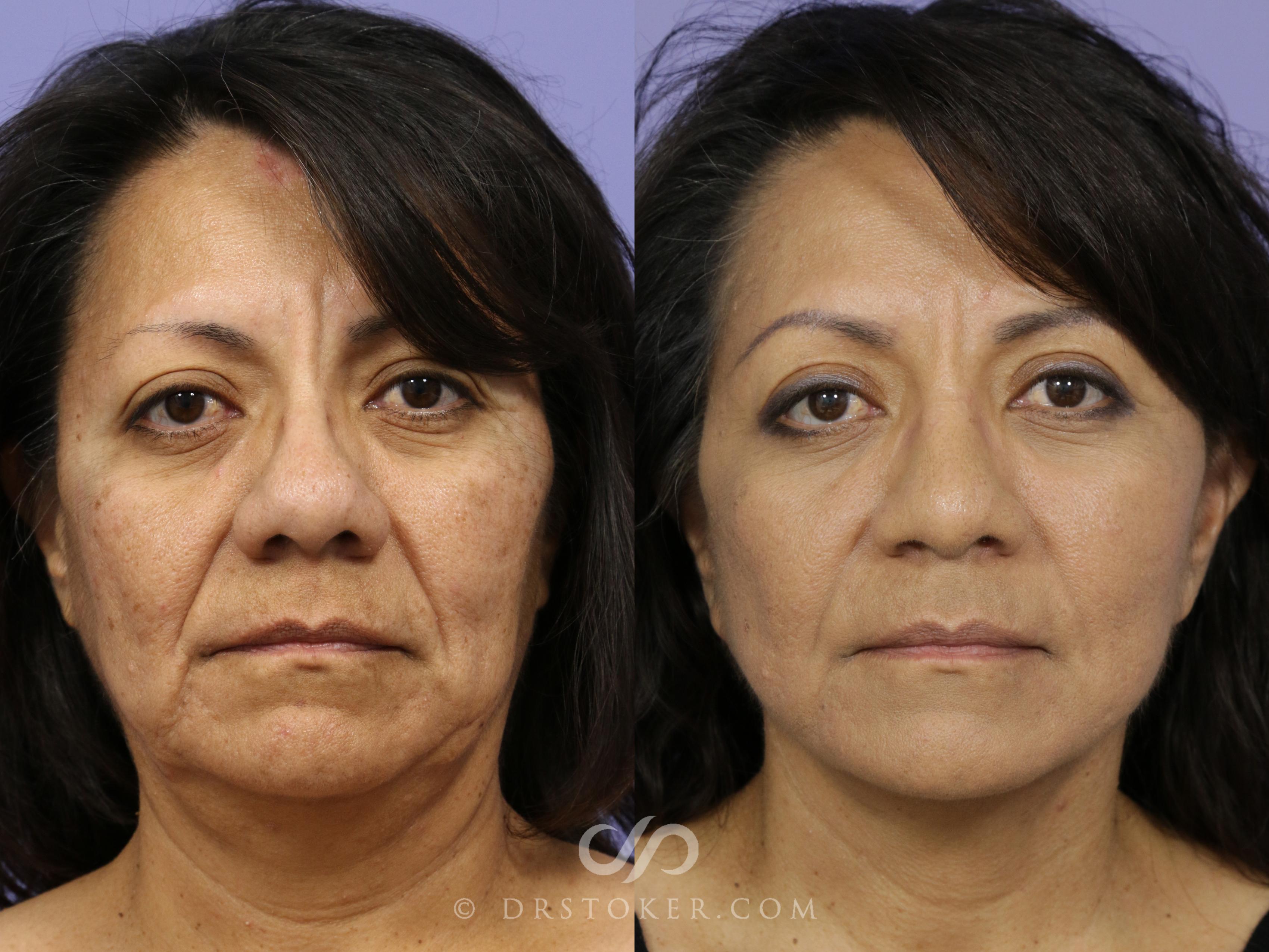 Before & After Rhinoplasty Case 1122 View #1 View in Los Angeles, CA