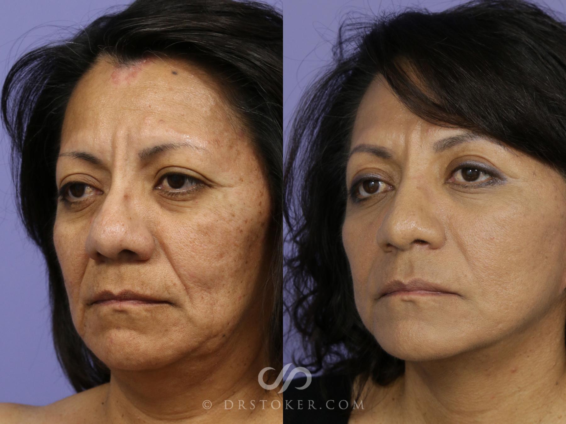 Before & After Rhinoplasty Case 1122 View #2 View in Los Angeles, CA
