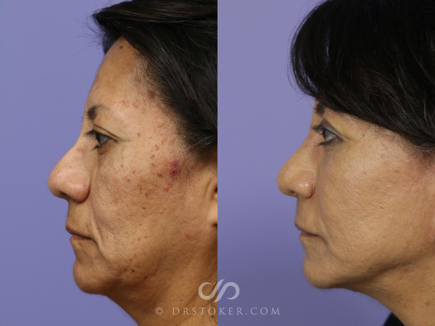 Before & After Rhinoplasty Case 1122 View #3 View in Los Angeles, CA