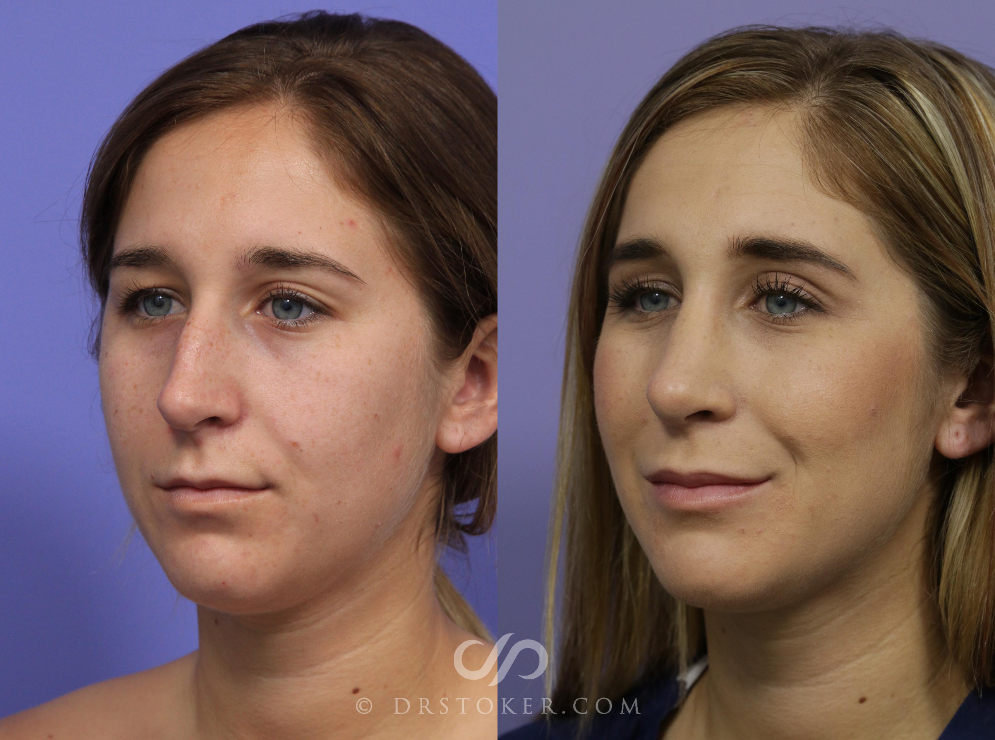 Before & After Rhinoplasty Case 1125 View #1 View in Los Angeles, CA