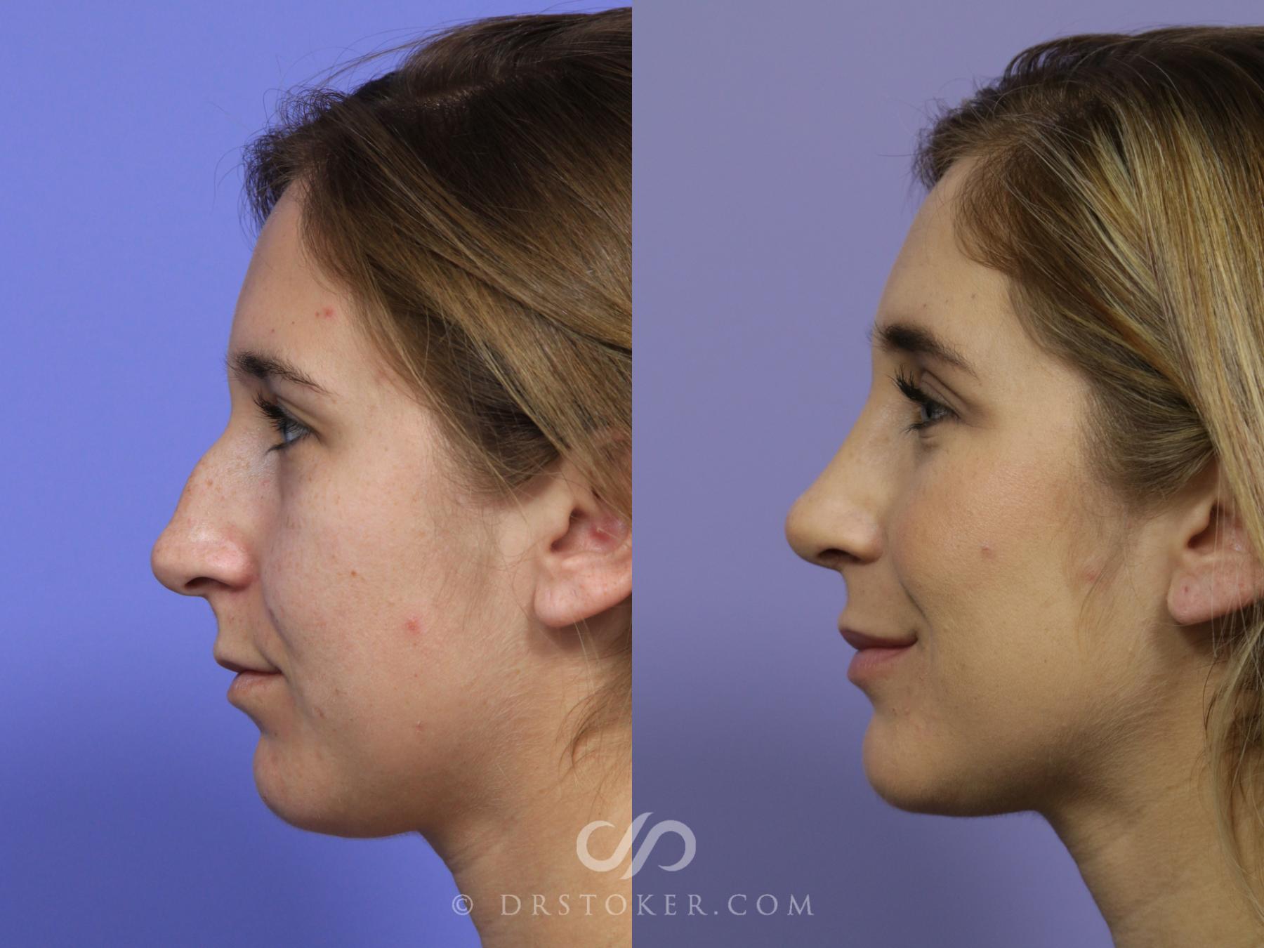 Before & After Rhinoplasty Case 1125 View #2 View in Los Angeles, CA