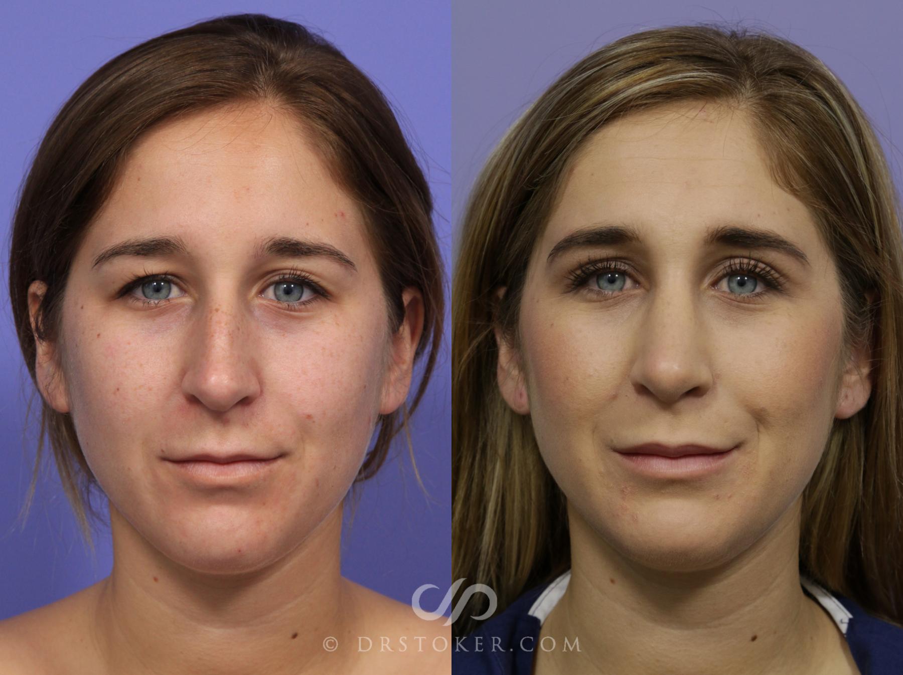 Before & After Rhinoplasty Case 1125 View #3 View in Los Angeles, CA