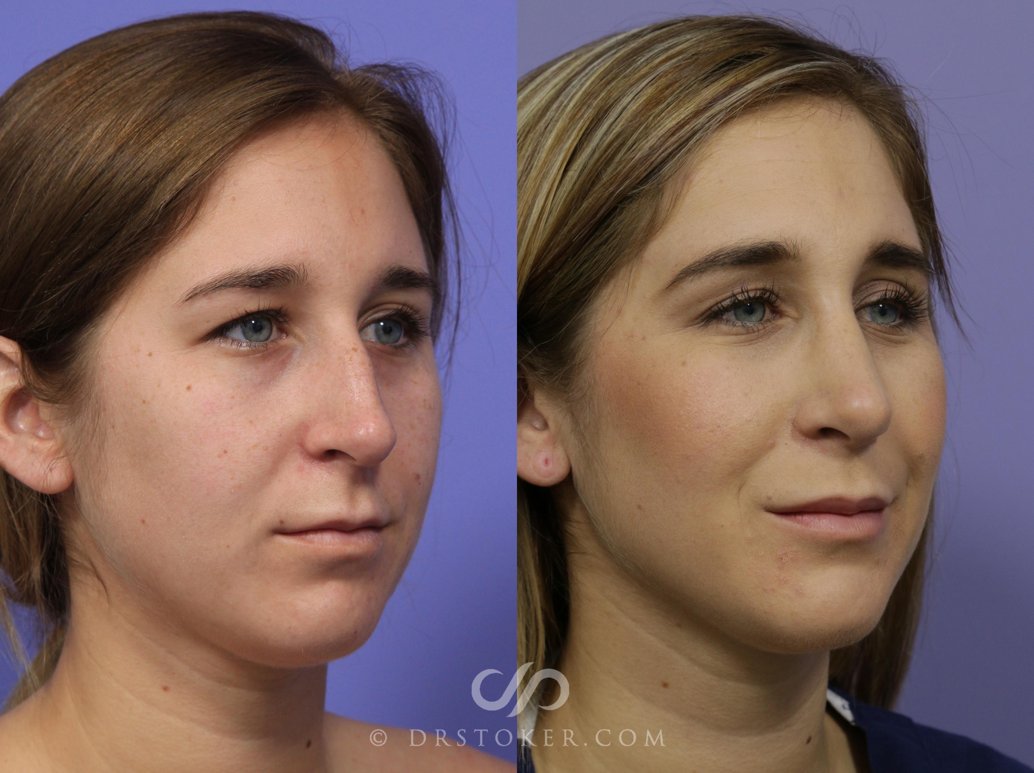 Before & After Rhinoplasty Case 1125 View #4 View in Los Angeles, CA