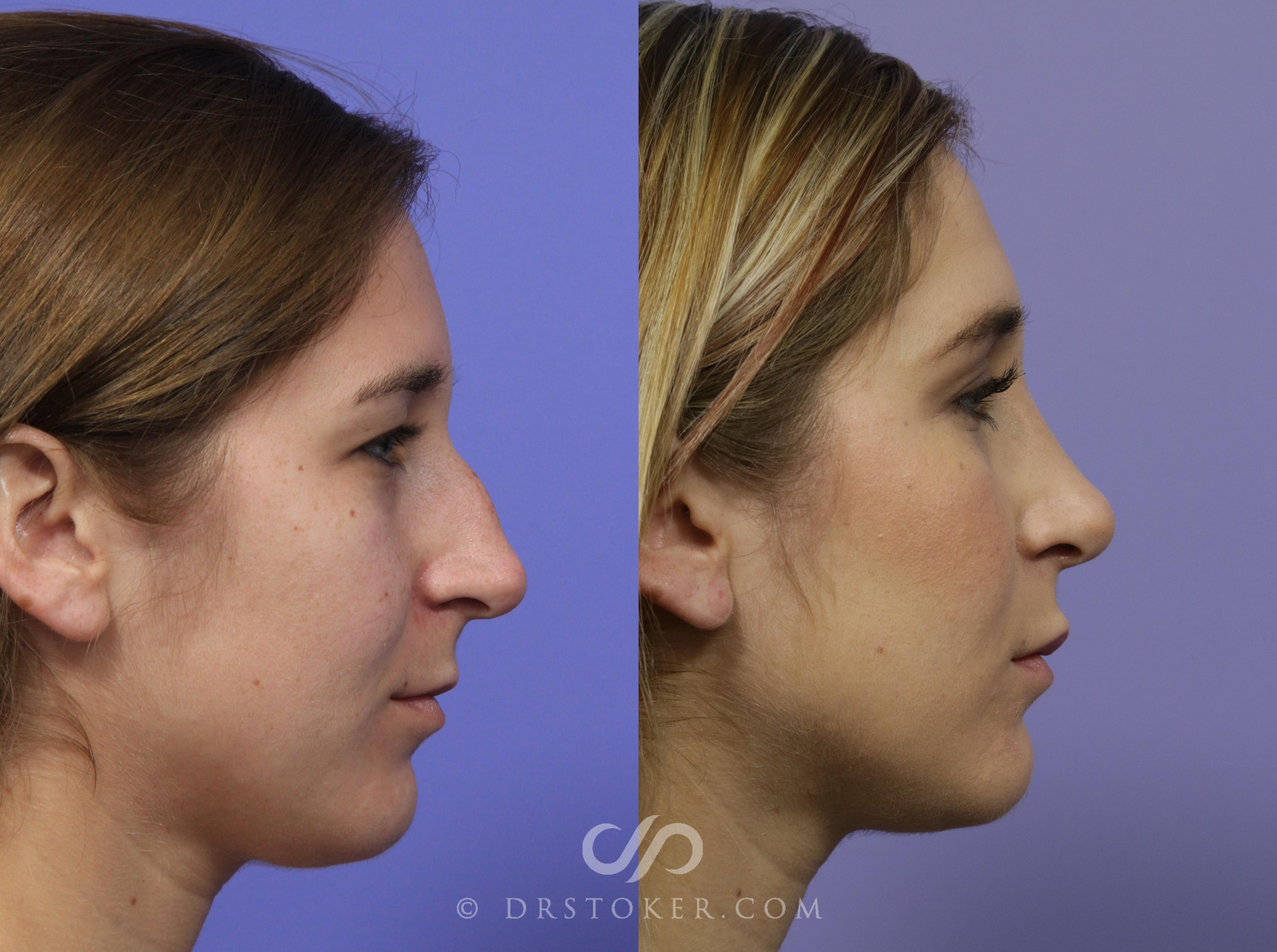 Before & After Rhinoplasty Case 1125 View #5 View in Los Angeles, CA