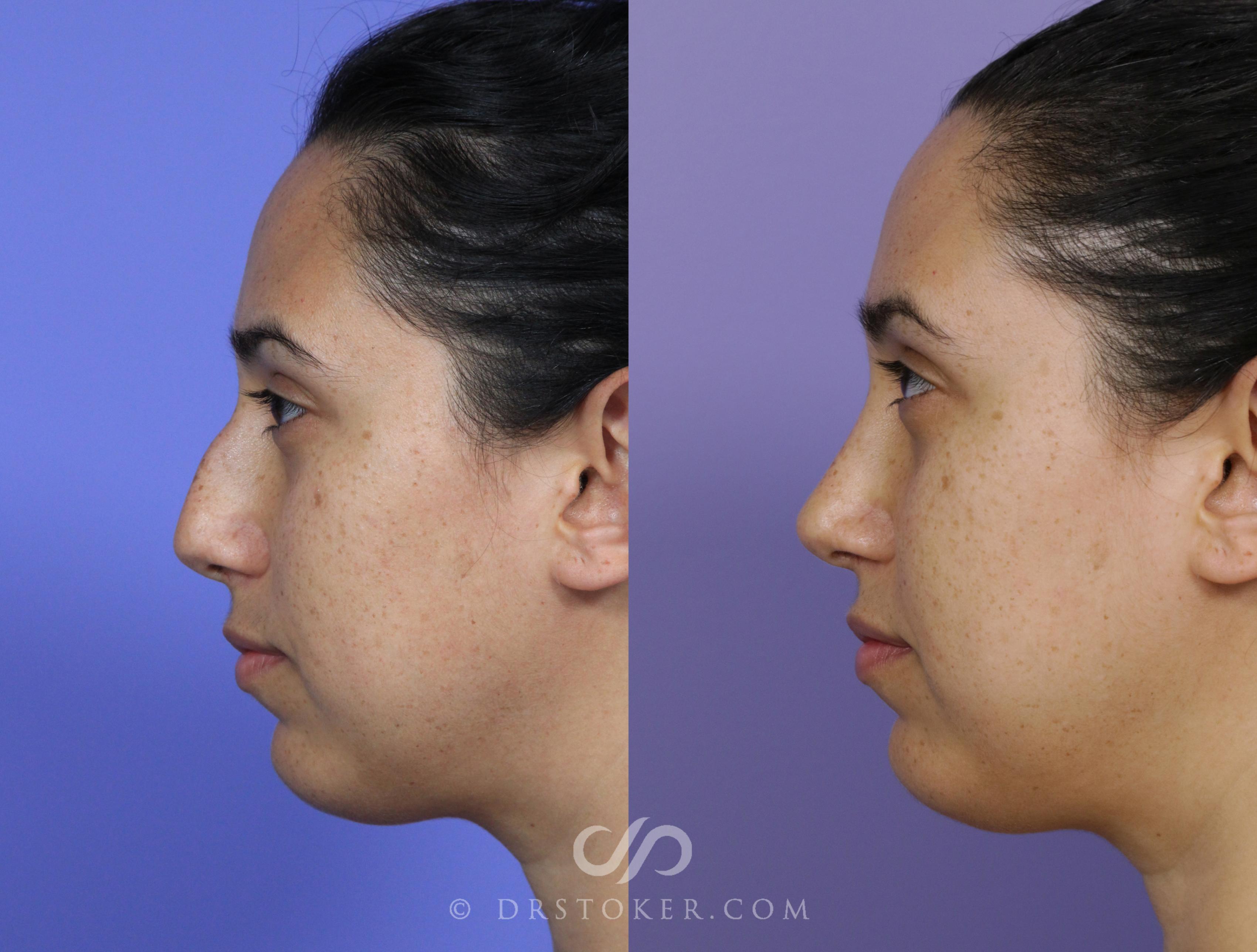 Before & After Rhinoplasty Case 1126 View #2 View in Los Angeles, CA