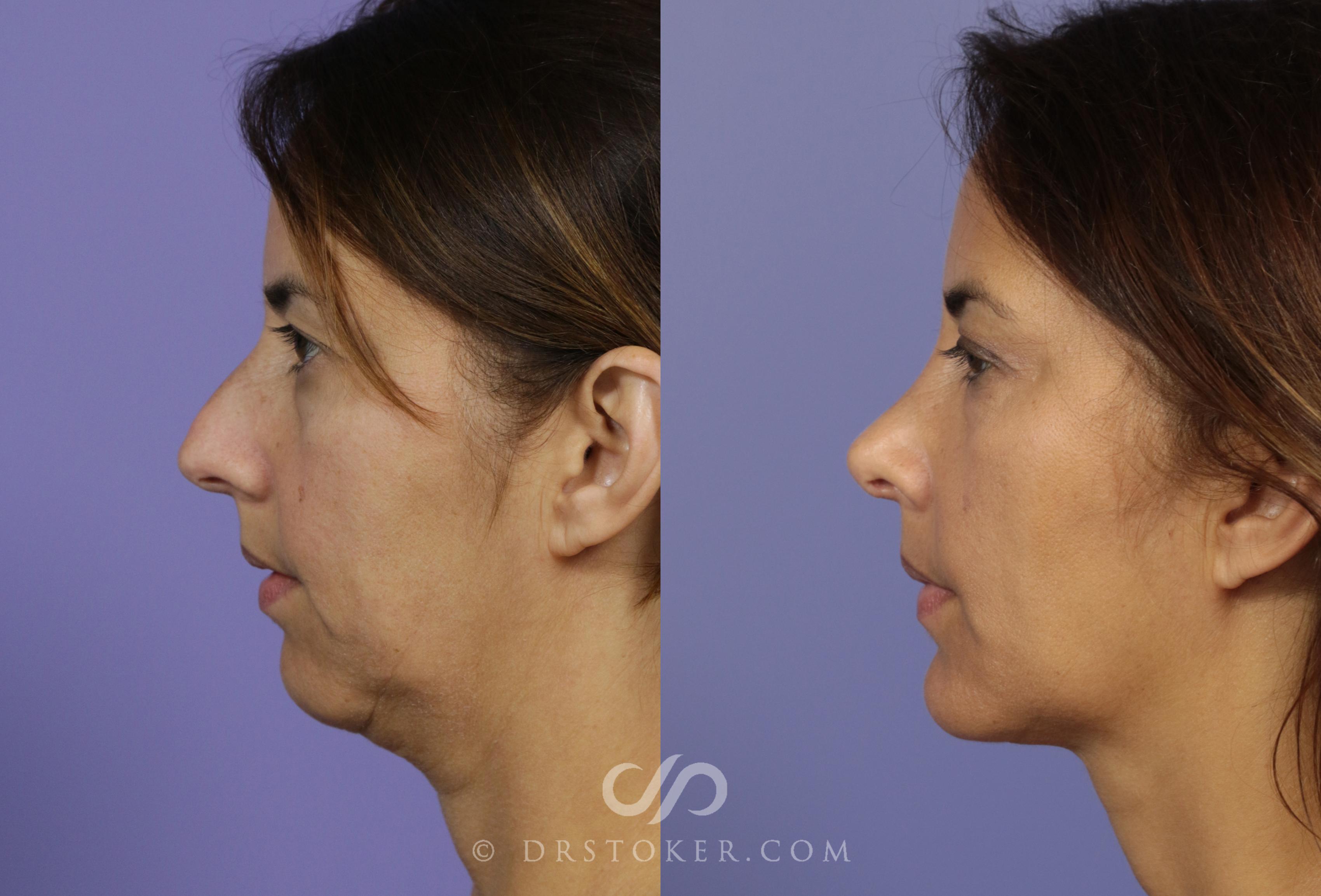 Before & After Rhinoplasty Case 1127 View #1 View in Los Angeles, CA