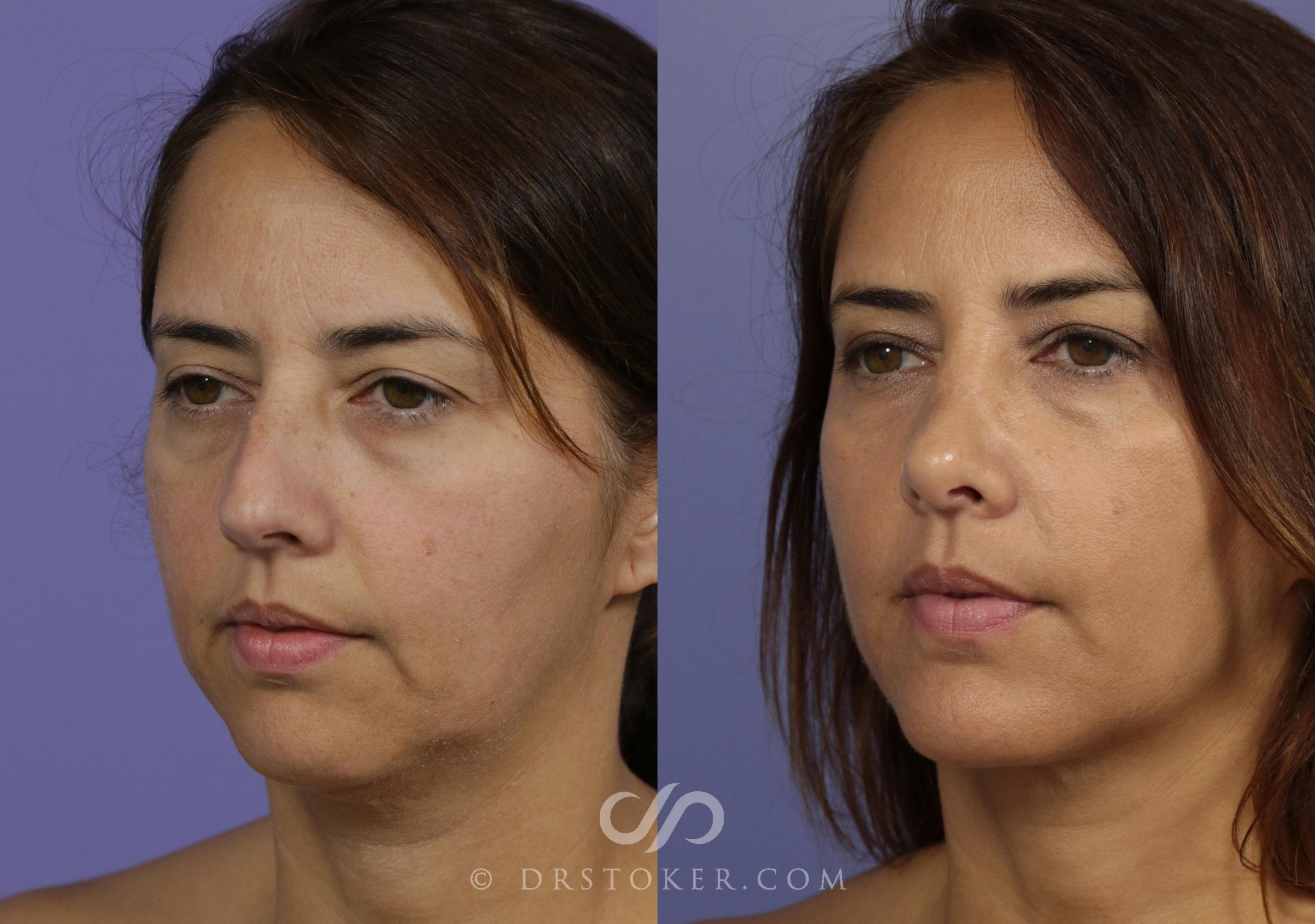 Before & After Rhinoplasty Case 1127 View #2 View in Los Angeles, CA