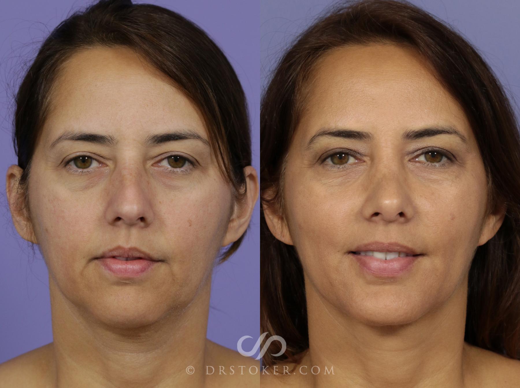 Before & After Rhinoplasty Case 1127 View #3 View in Los Angeles, CA