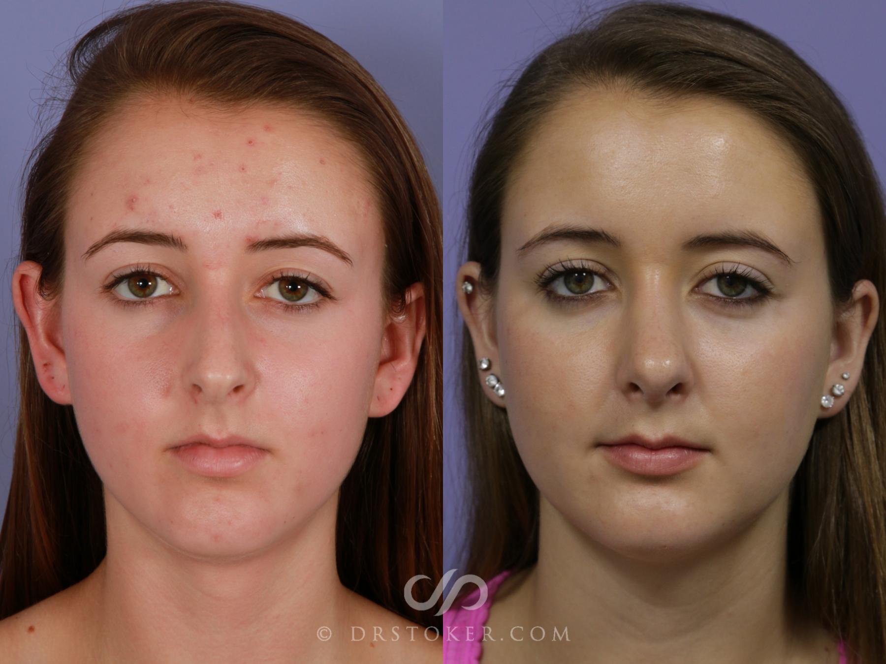 Before & After Rhinoplasty Case 1128 View #1 View in Los Angeles, CA