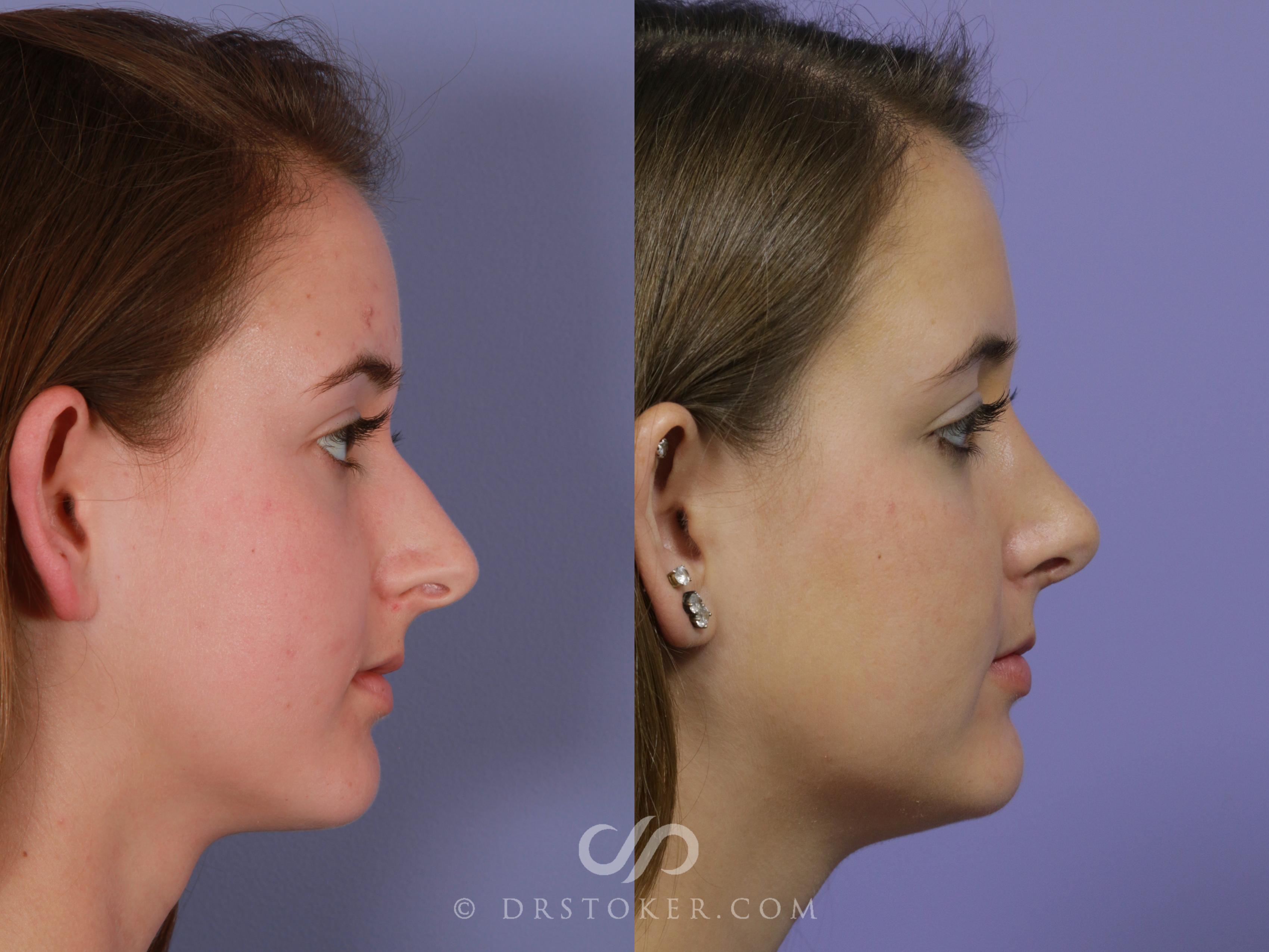 Before & After Rhinoplasty Case 1128 View #2 View in Los Angeles, CA