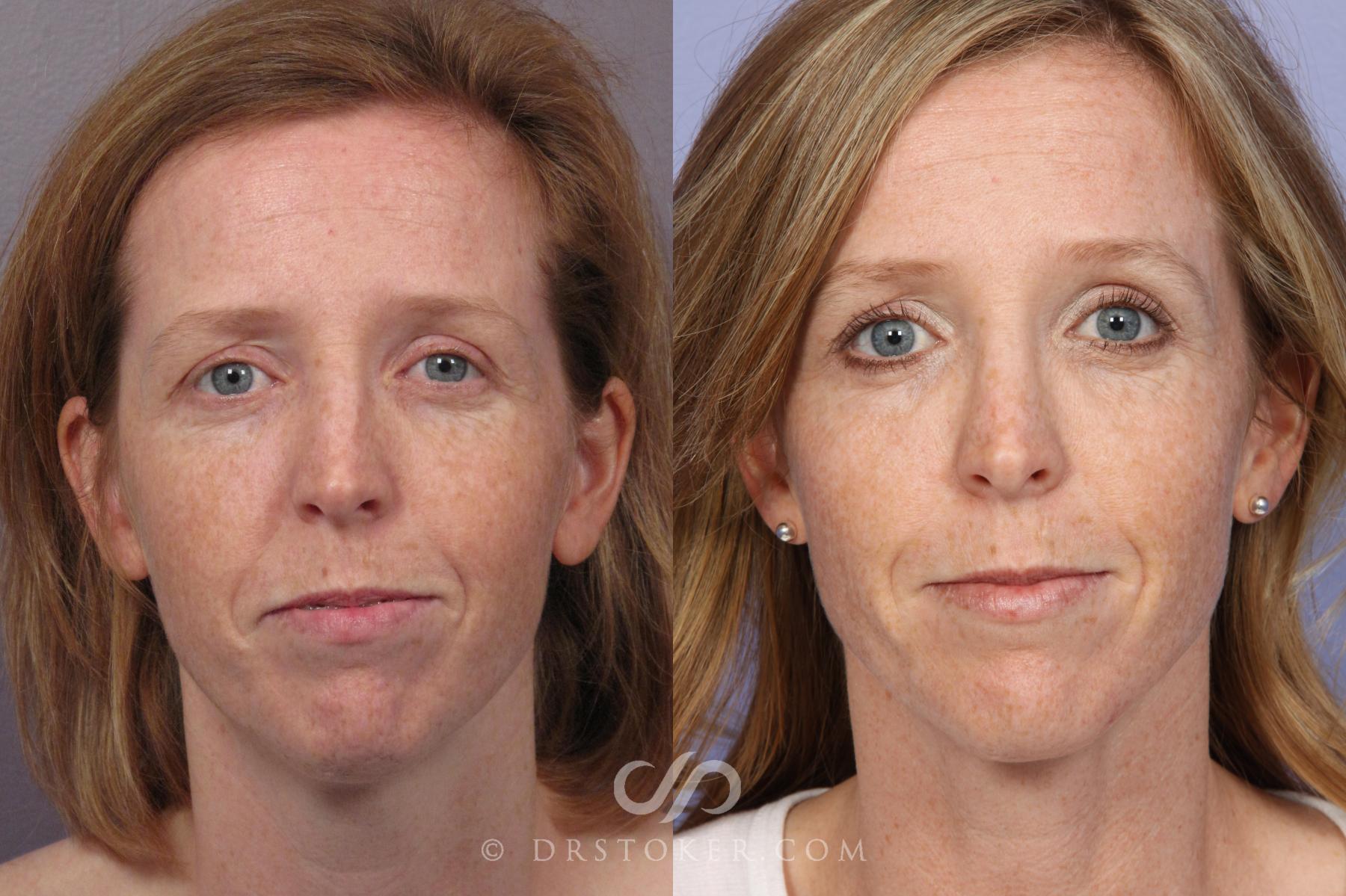 Before & After Rhinoplasty Case 1246 View #1 View in Los Angeles, CA