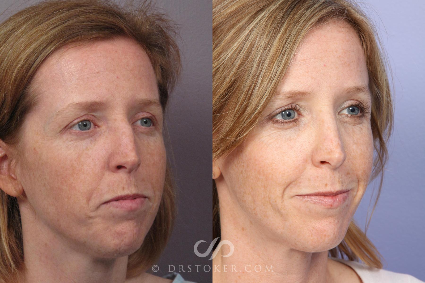 Before & After Rhinoplasty Case 1246 View #2 View in Los Angeles, CA