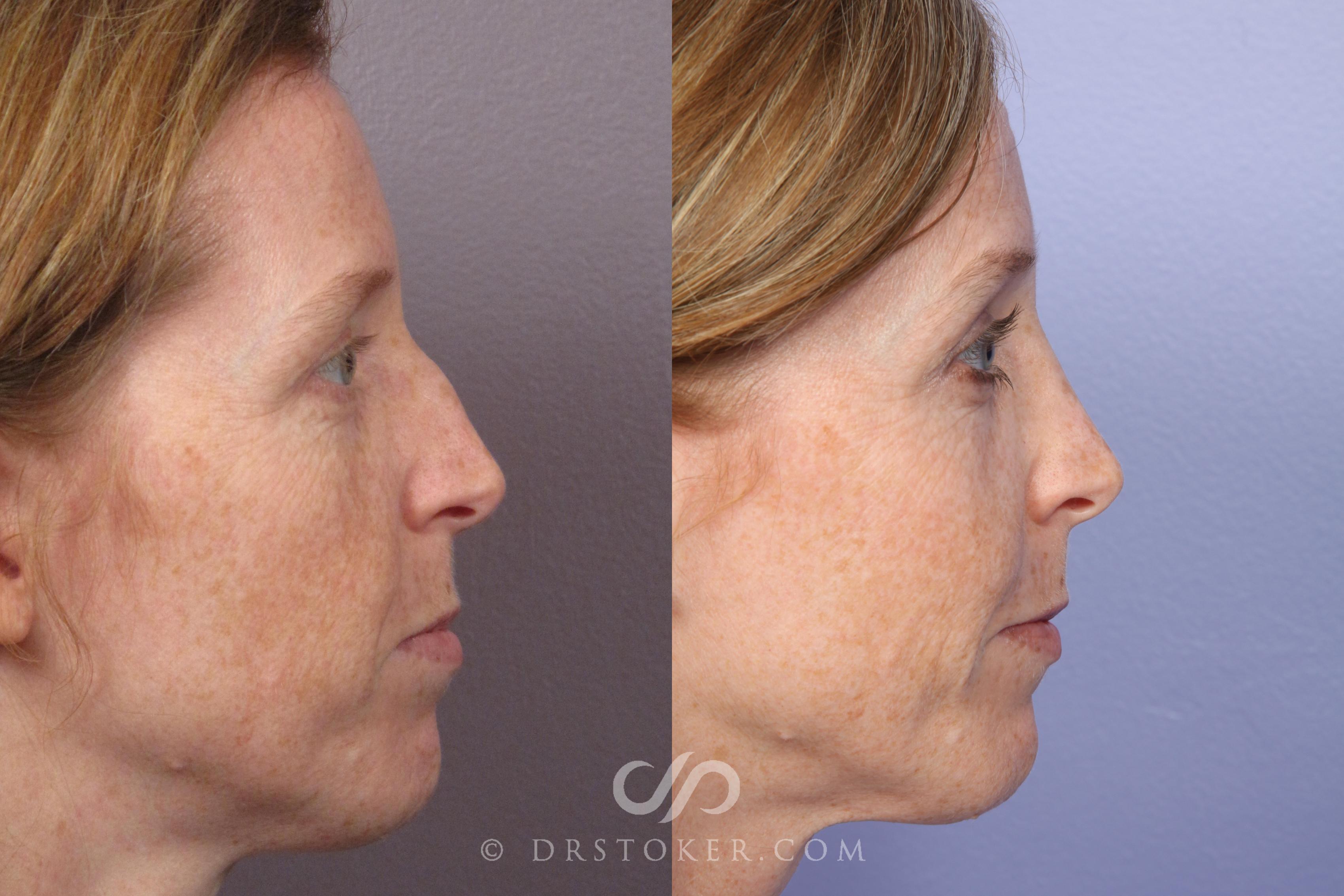 Before & After Rhinoplasty Case 1246 View #3 View in Los Angeles, CA