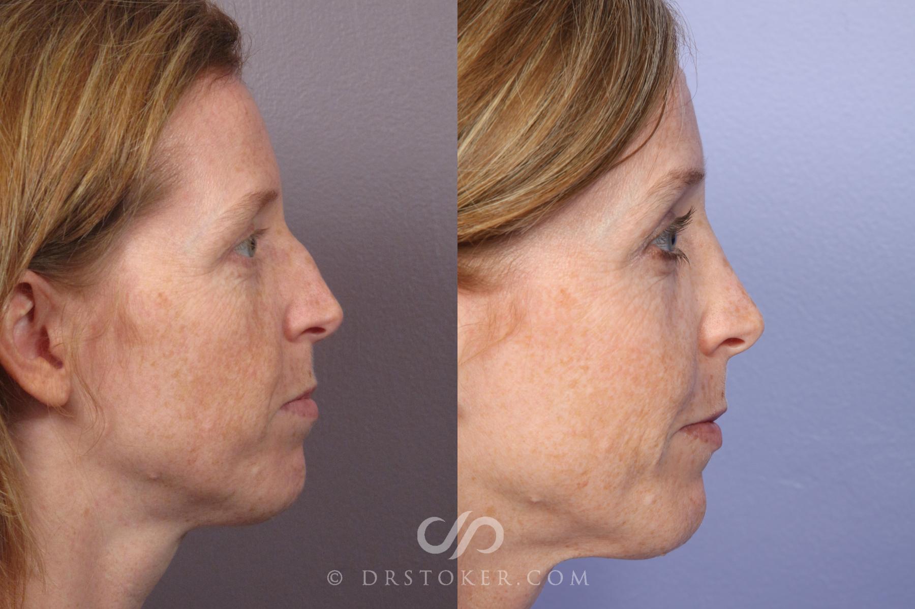 Before & After Rhinoplasty Case 1246 View #3 View in Los Angeles, CA
