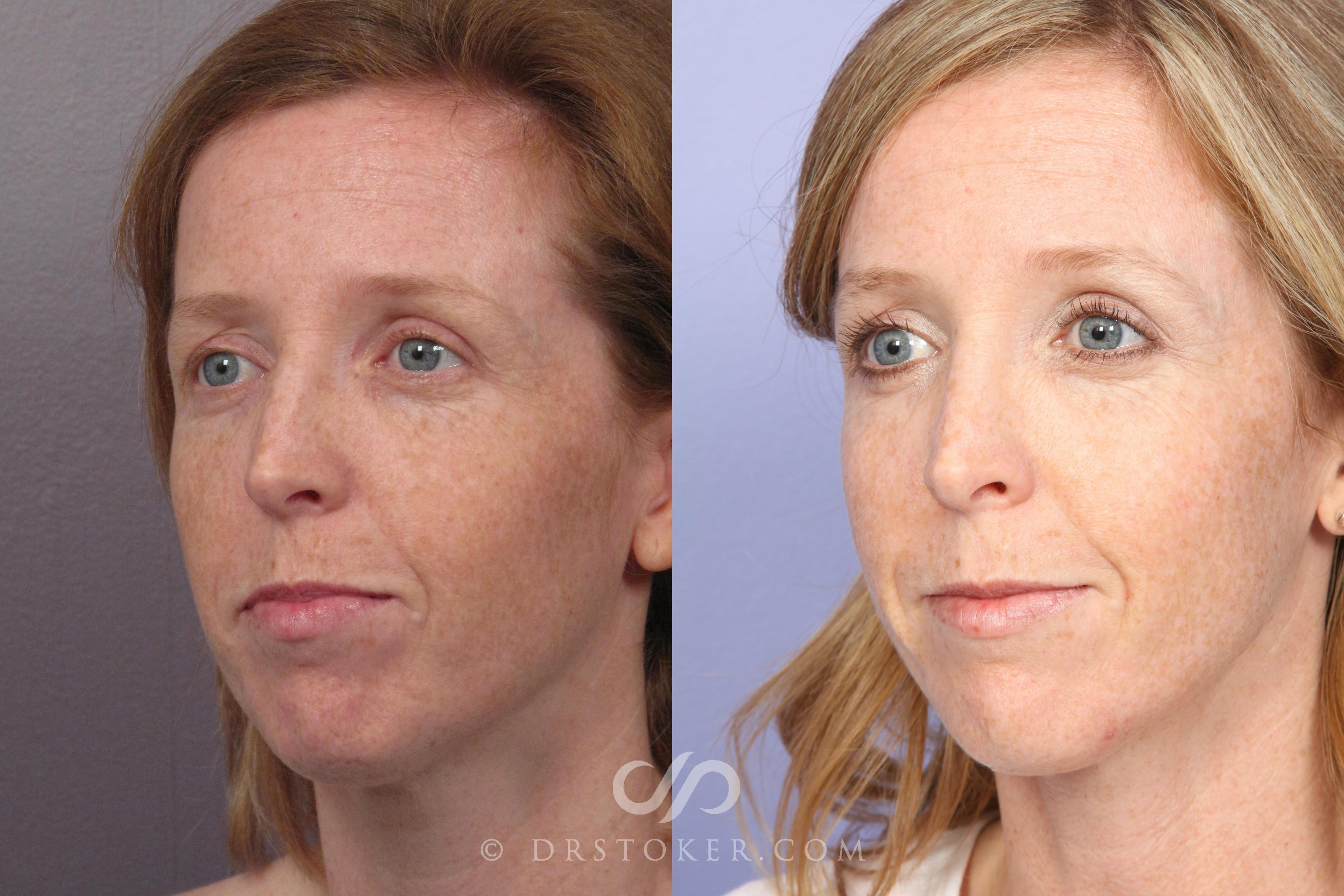 Before & After Rhinoplasty Case 1246 View #4 View in Los Angeles, CA