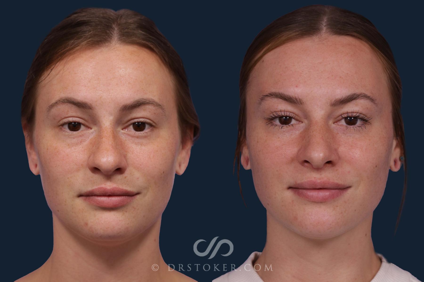Before & After Rhinoplasty Case 1924 Front View in Los Angeles, CA