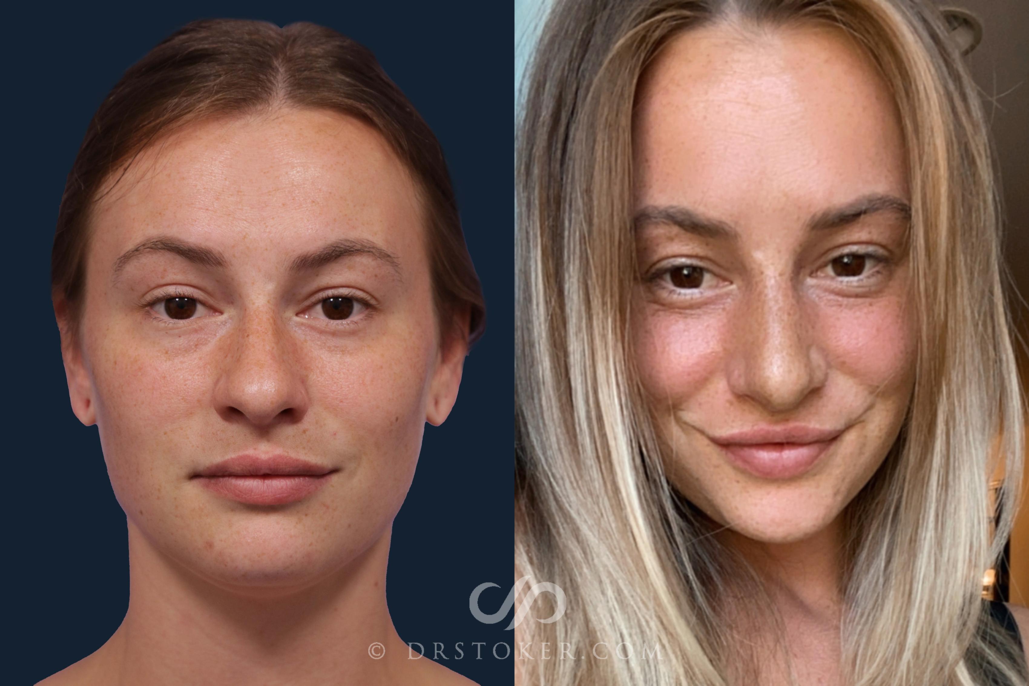 Before & After Rhinoplasty Case 1925 Front View in Los Angeles, CA