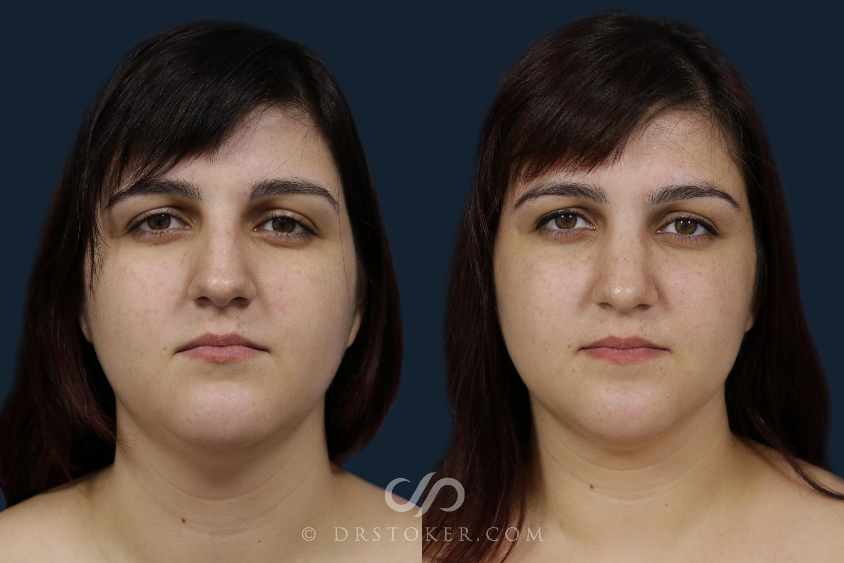 Before & After Rhinoplasty Case 1986 Front View in Los Angeles, CA