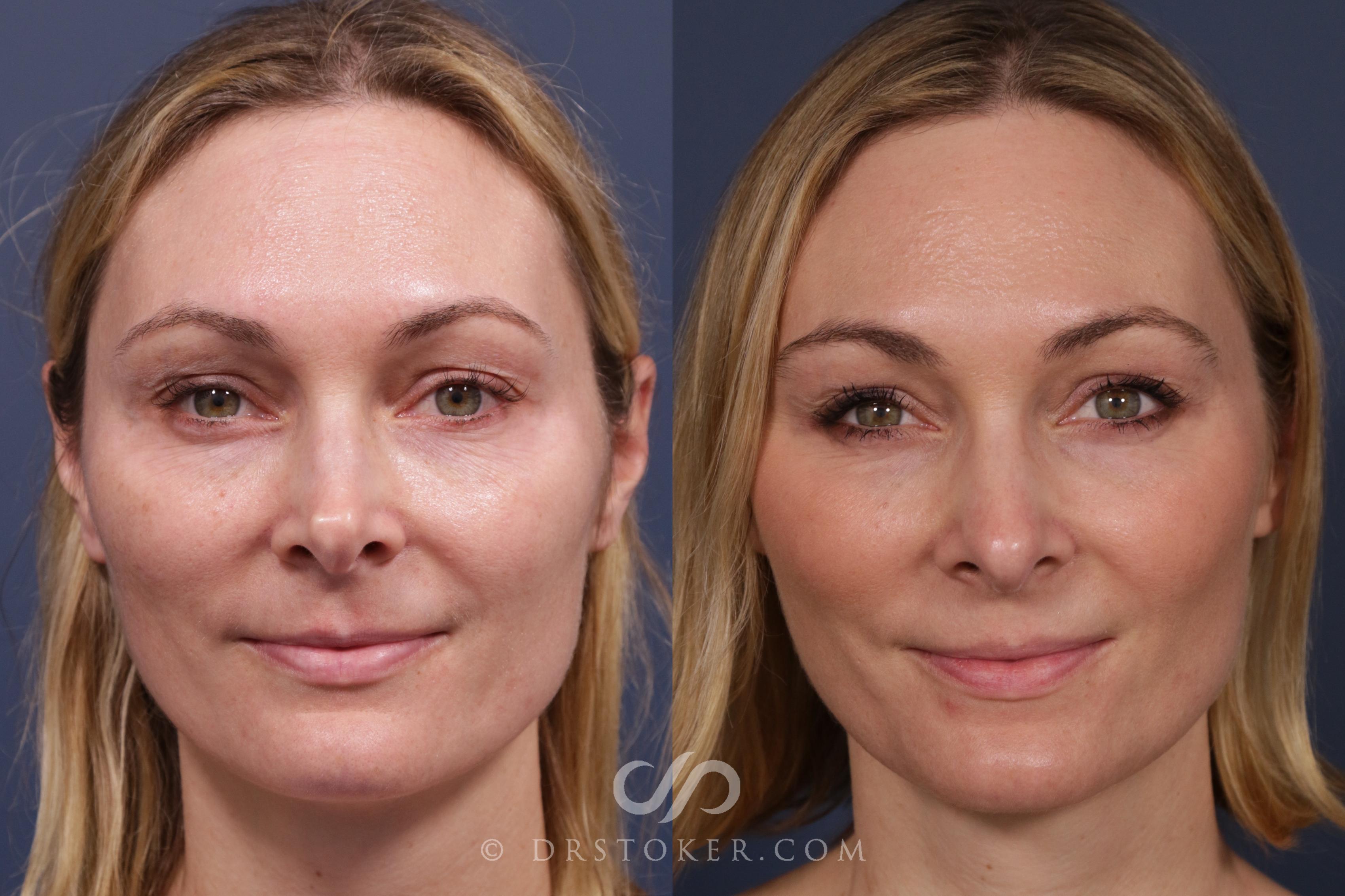 Before & After Rhinoplasty Case 2012 Front View in Los Angeles, CA