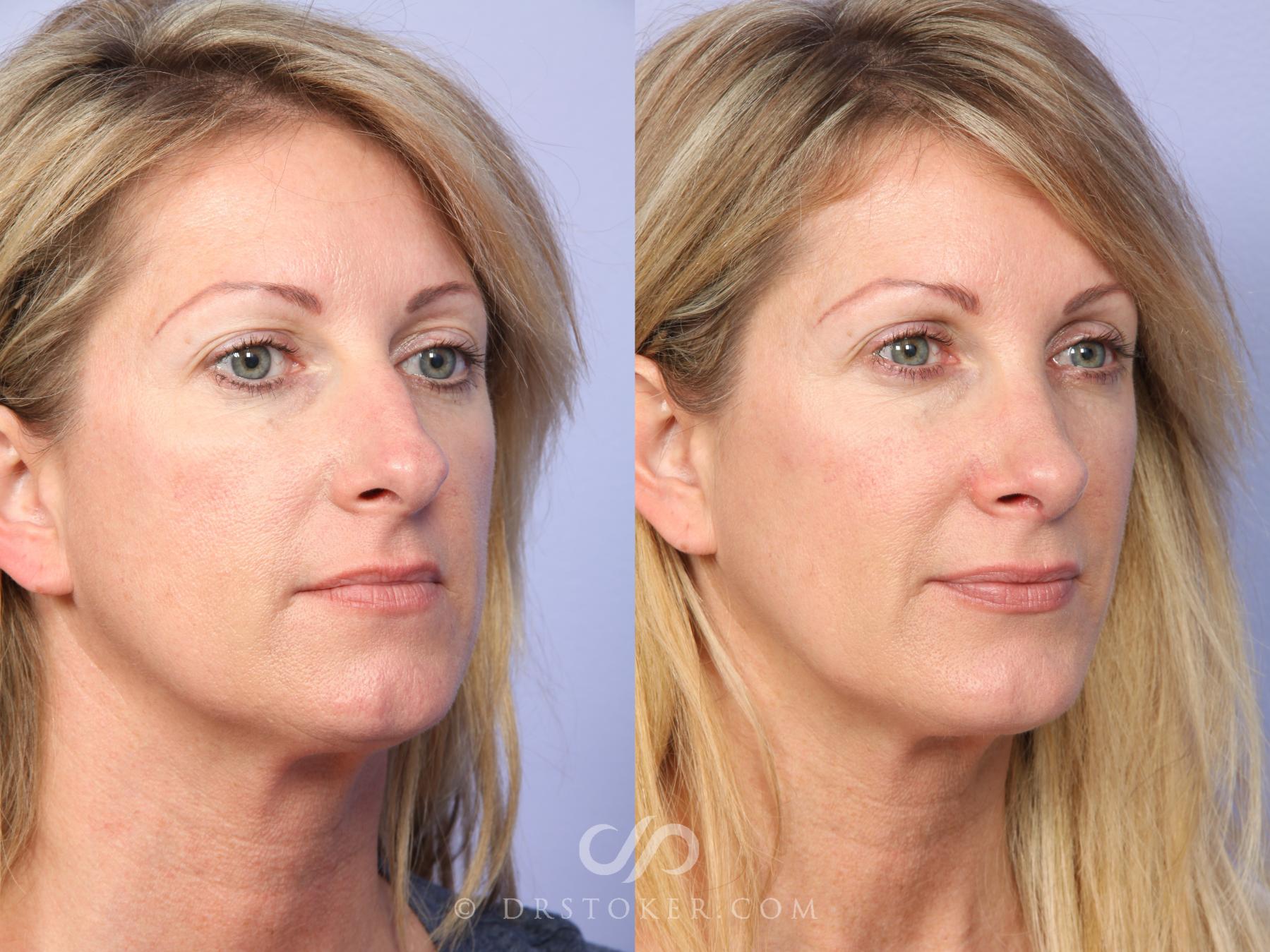 Before & After Rhinoplasty Case 2236 Right Oblique View in Los Angeles, CA