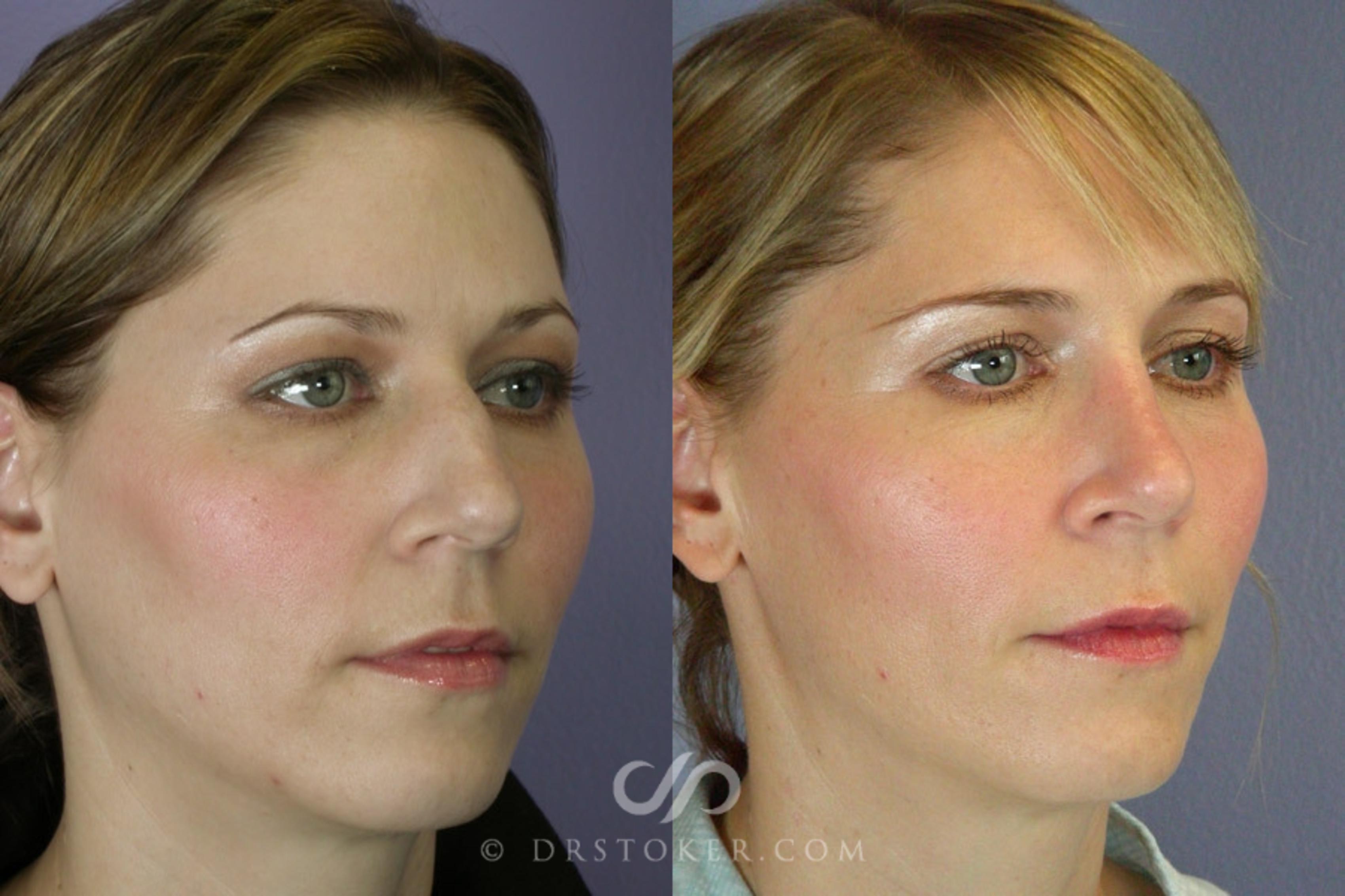 Before & After Rhinoplasty Case 2237 Right Oblique View in Los Angeles, CA