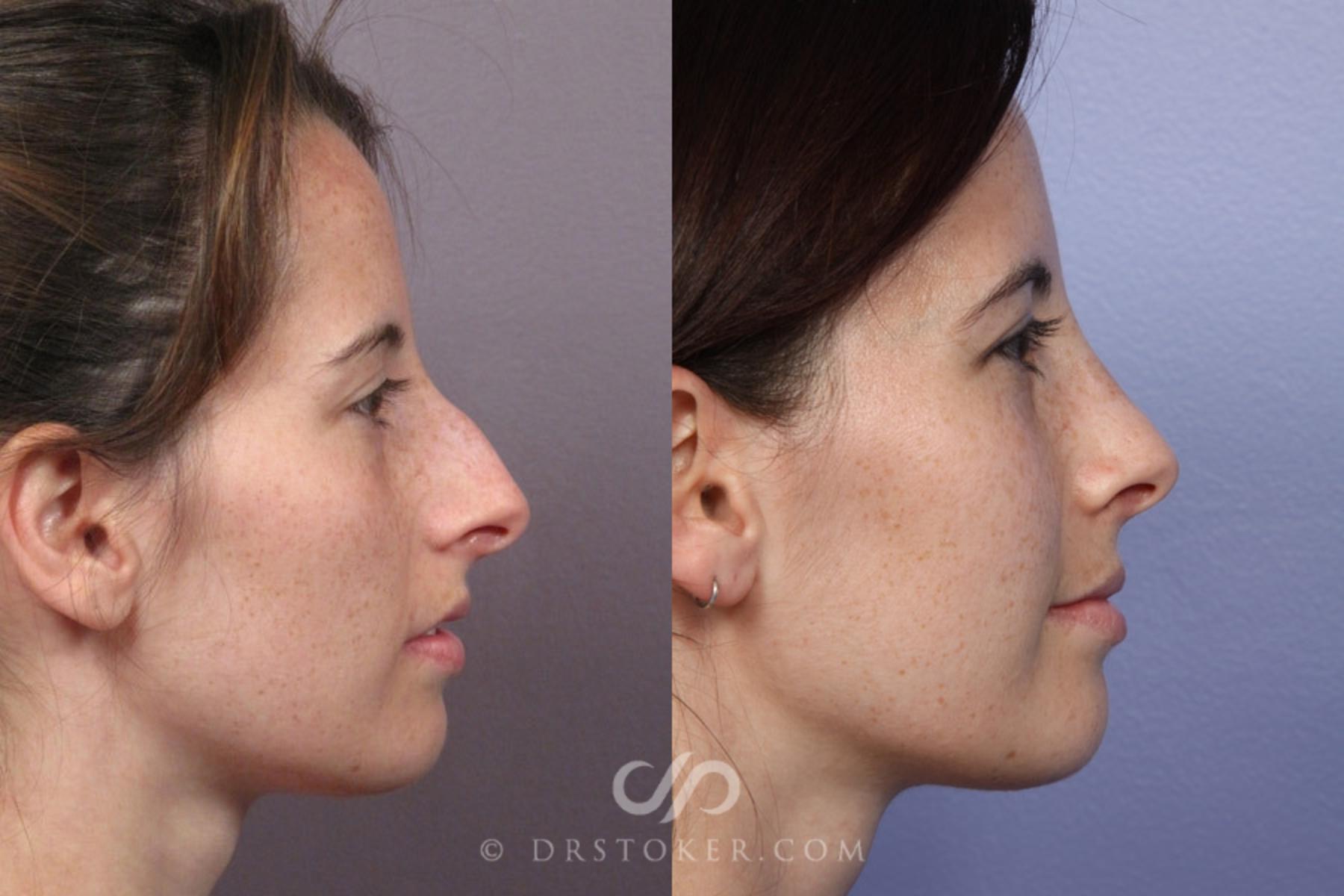 Before & After Rhinoplasty Case 2238 Right Side View in Los Angeles, CA