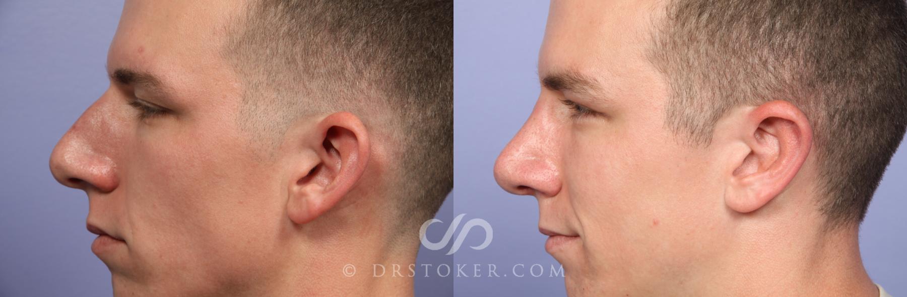 Before & After Rhinoplasty Case 2240 Left Side View in Los Angeles, CA