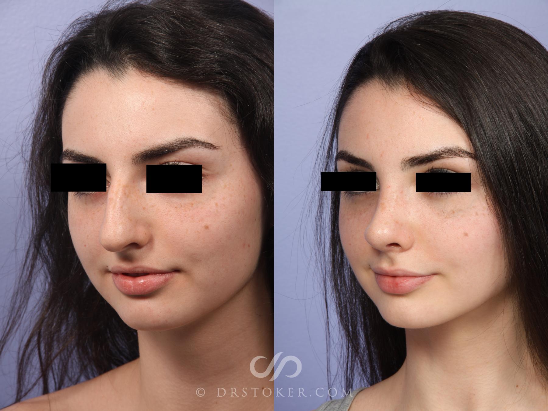 Before & After Rhinoplasty Case 2241 Left Oblique View in Los Angeles, CA