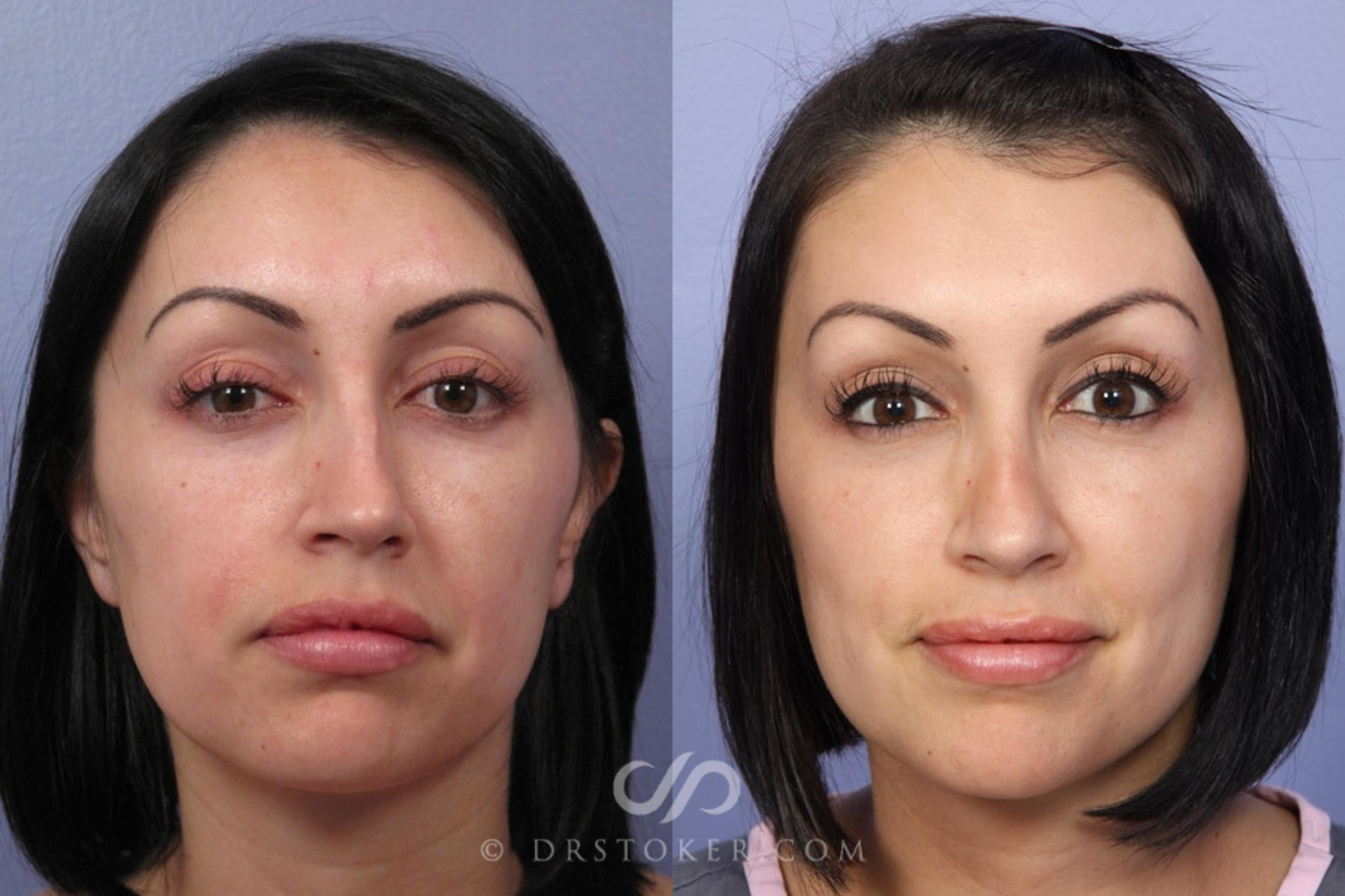 Before & After Rhinoplasty Case 2242 Front View in Los Angeles, CA