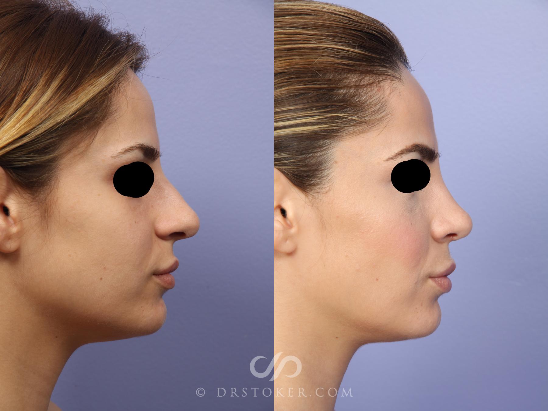 Before & After Rhinoplasty Case 2243 Right Side View in Los Angeles, CA