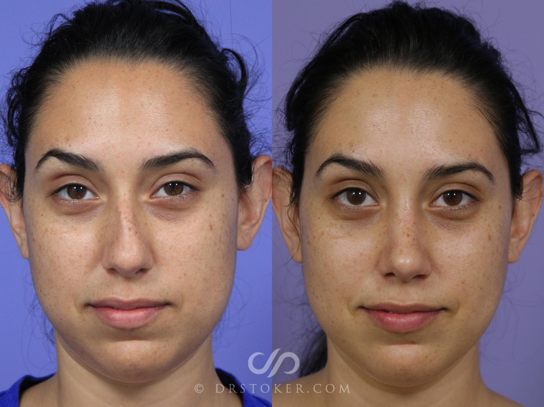 Before & After Rhinoplasty Case 2244 Front View in Los Angeles, CA