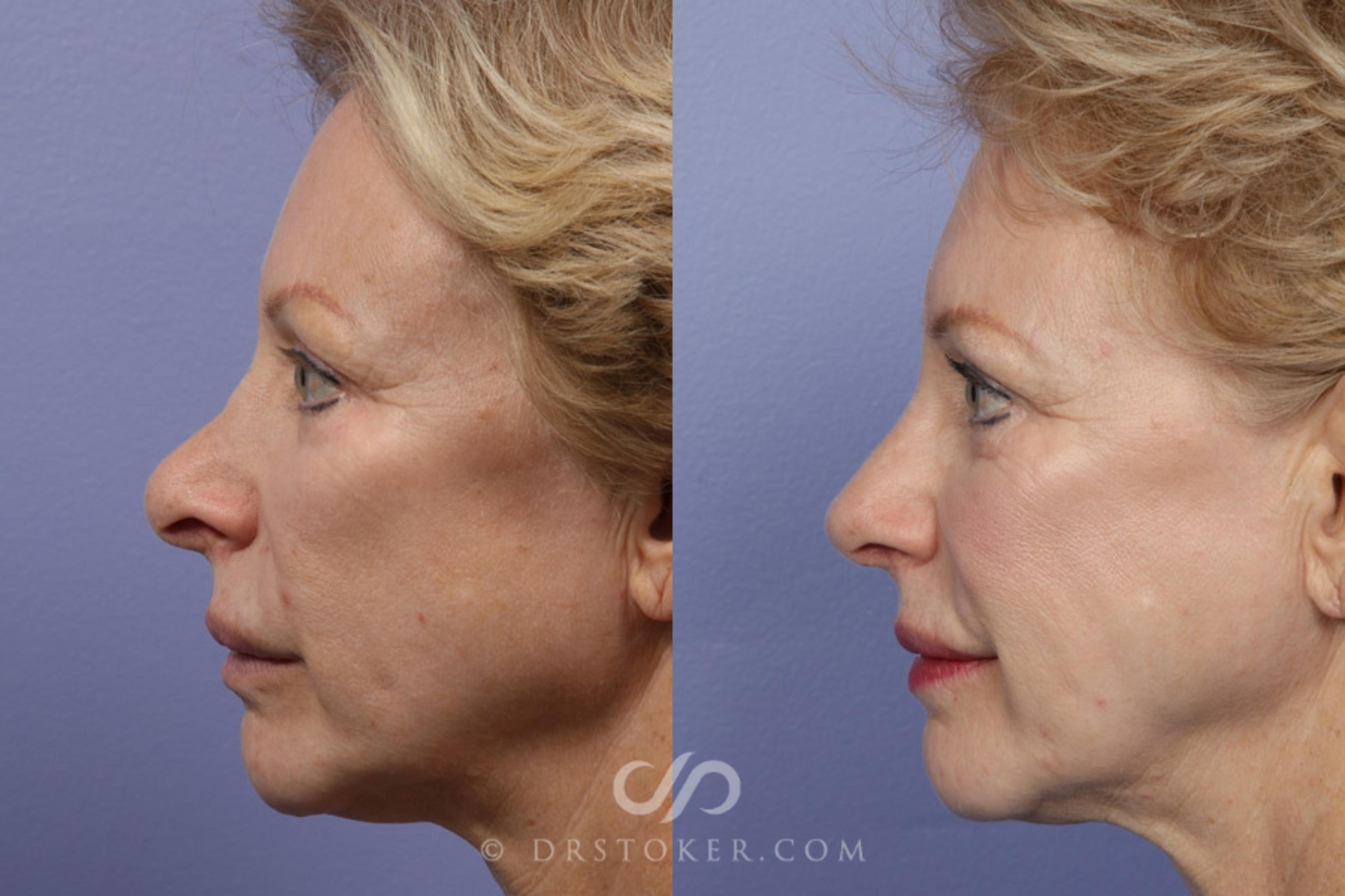 Before & After Rhinoplasty Case 2245 Left Side View in Los Angeles, CA