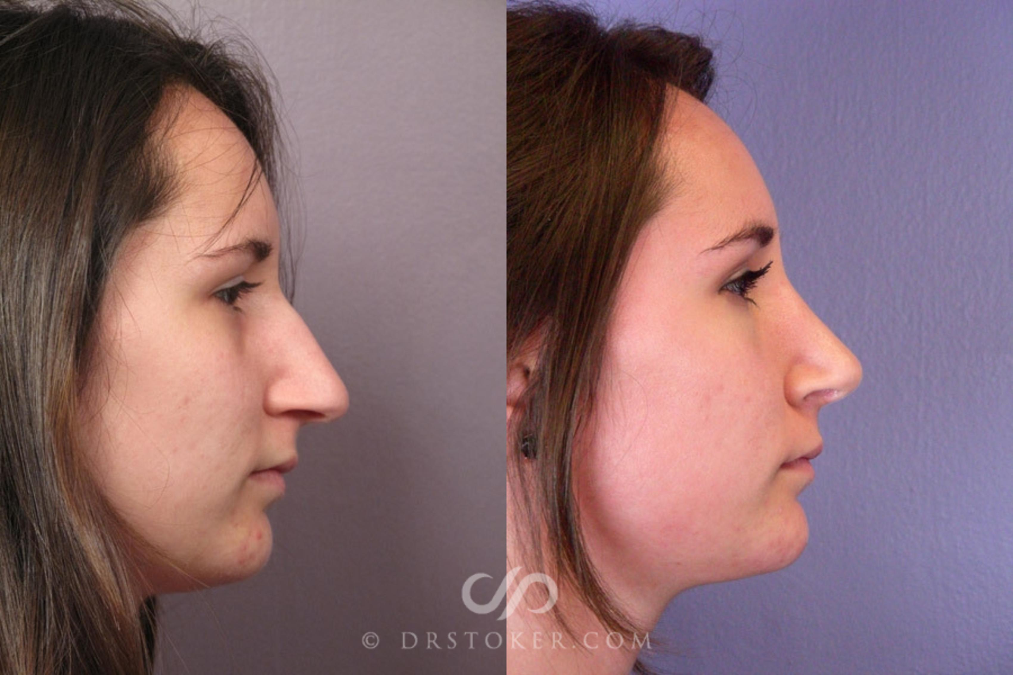 Before & After Rhinoplasty Case 2246 Right Side View in Los Angeles, CA