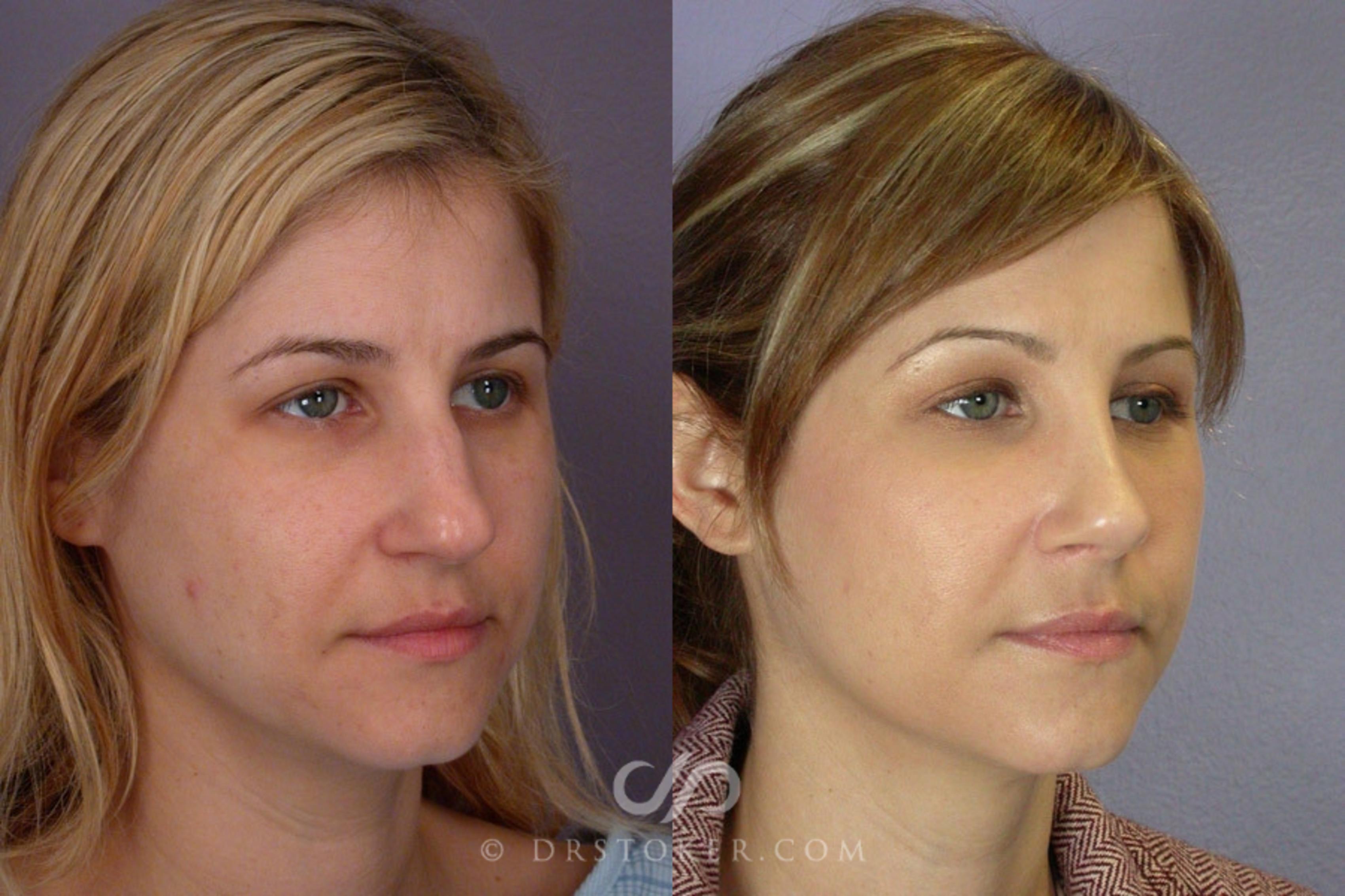 Before & After Rhinoplasty Case 2247 Right Oblique View in Los Angeles, CA