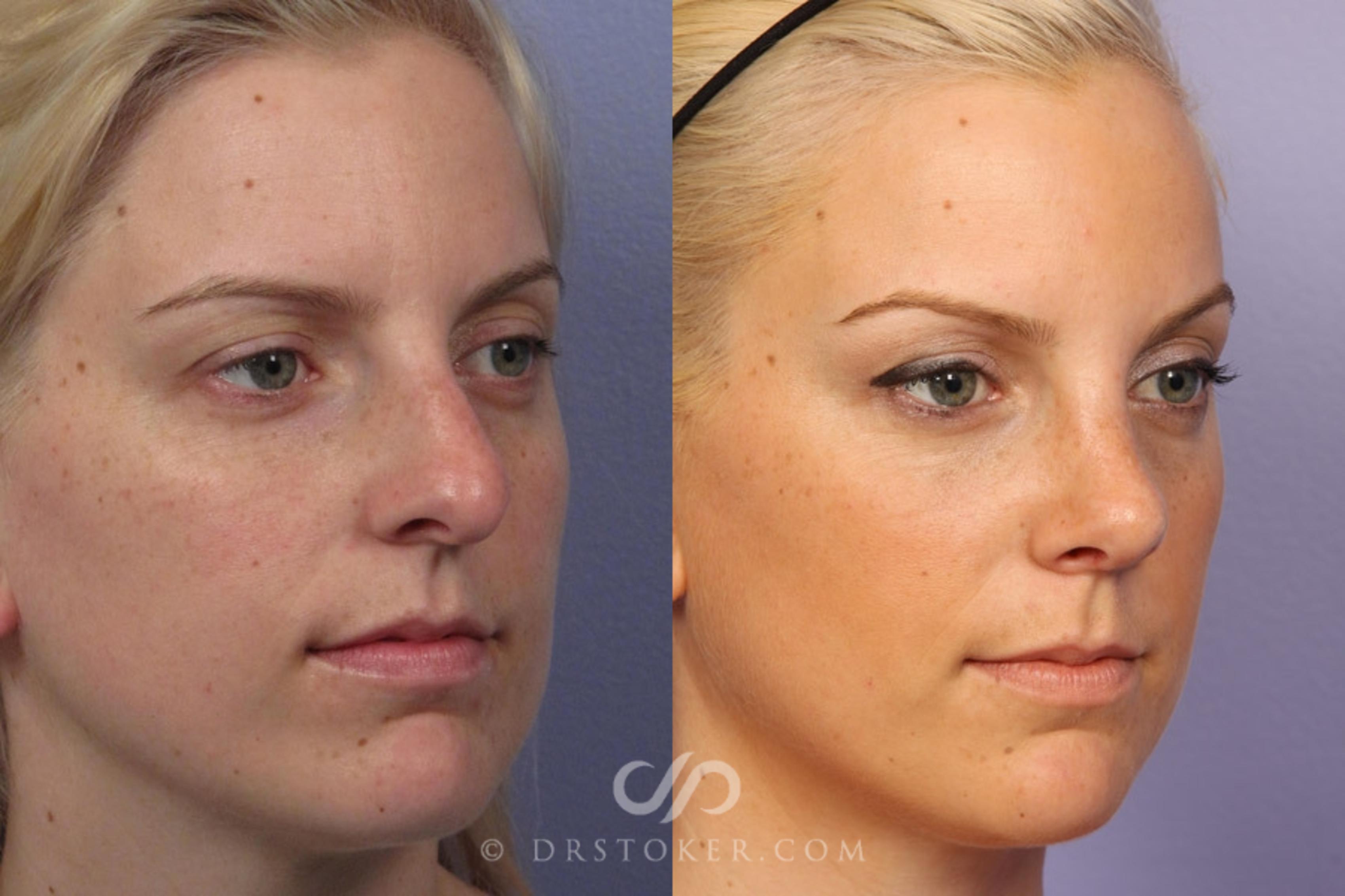 Before & After Rhinoplasty Case 2248 Right Oblique View in Los Angeles, CA